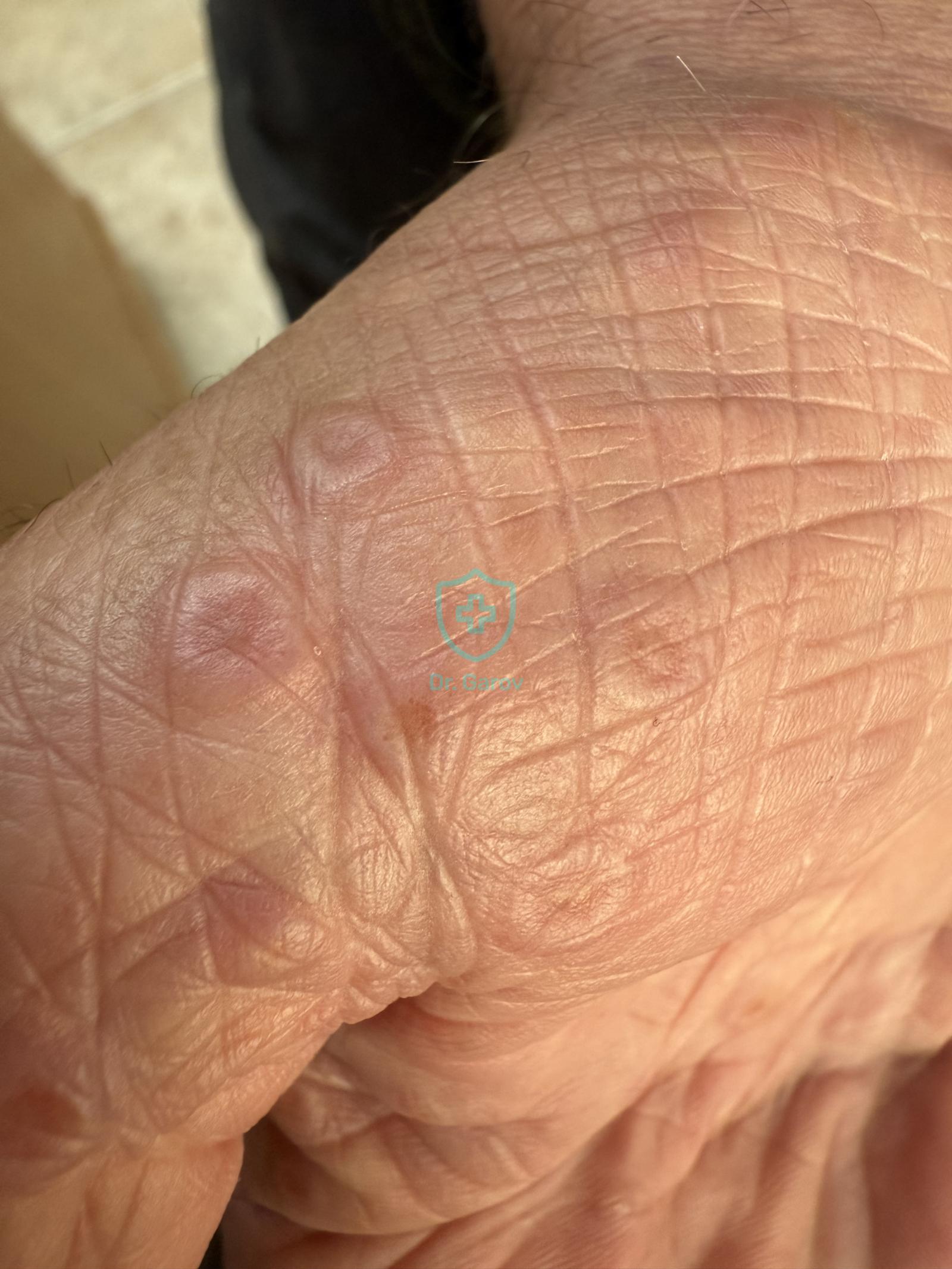 Erythema exsudativum multiforme