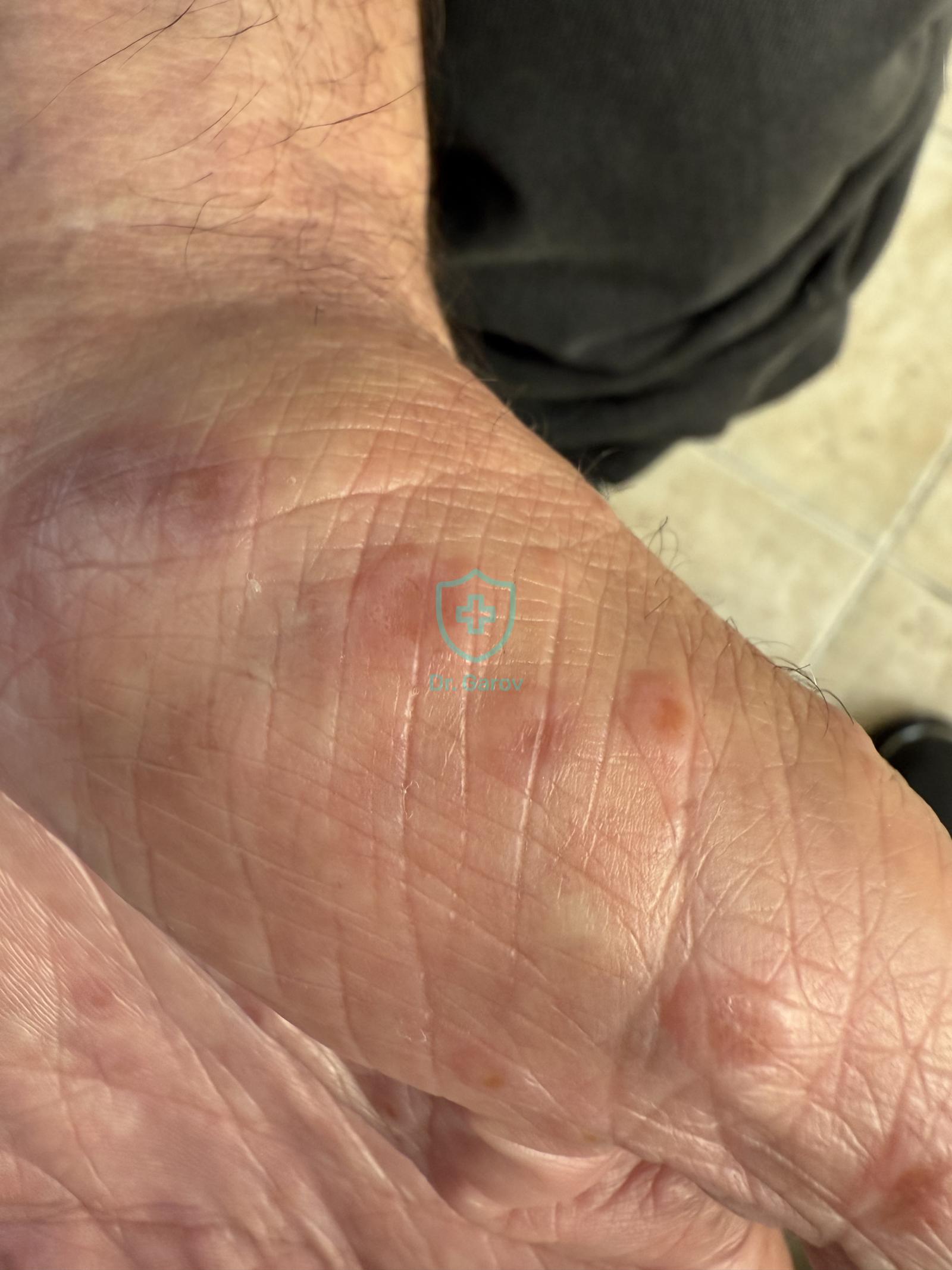 Erythema  multiforme