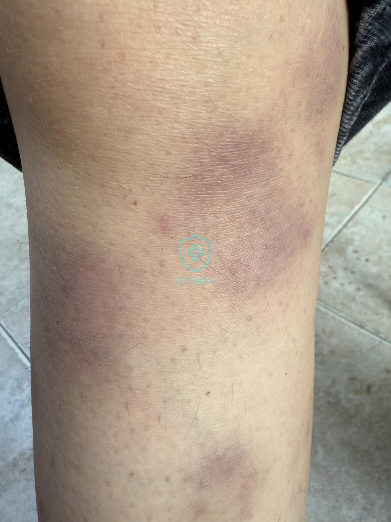 Erythema contusiforme