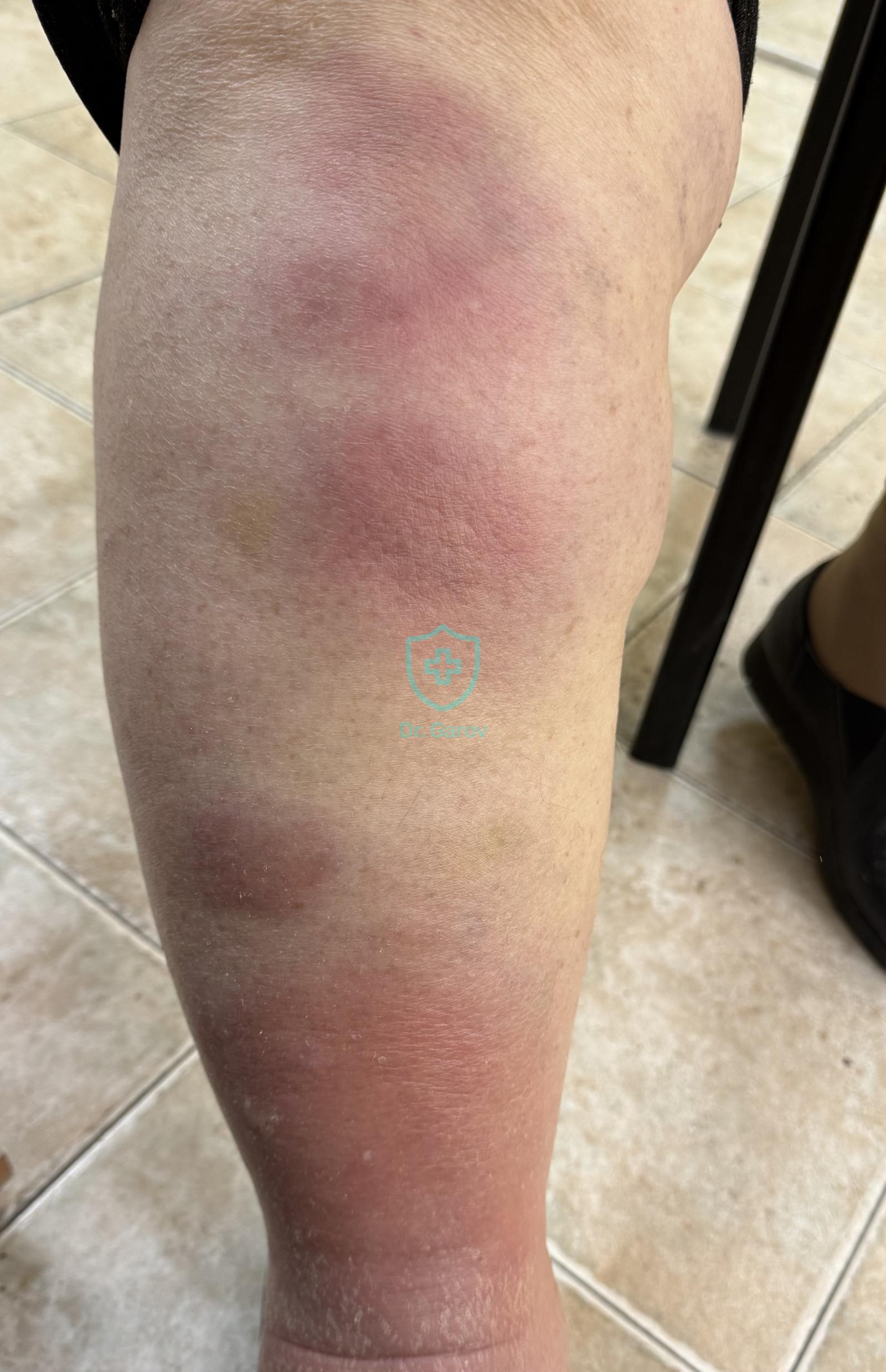 Erythema nodosum
