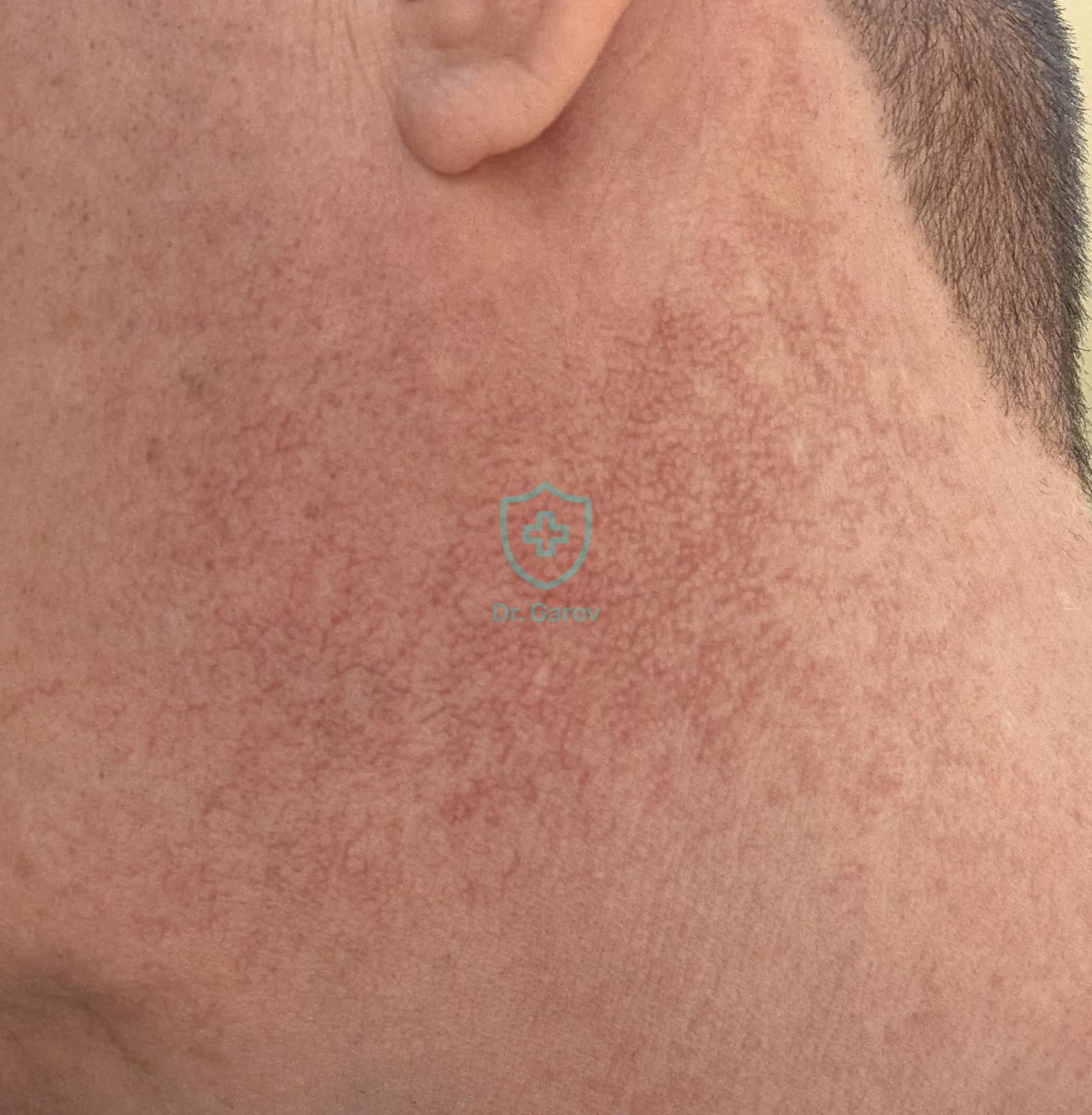 Erythrosis interfollicularis colli