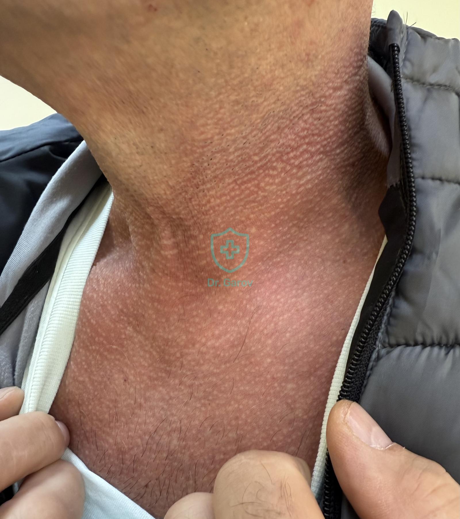 Erythrosis interfollicularis colli