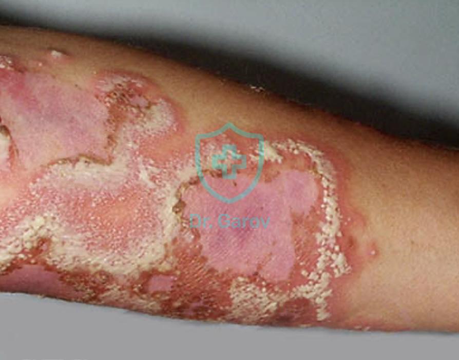 Impetigo herpetiformis (Hebra-Kaposi)