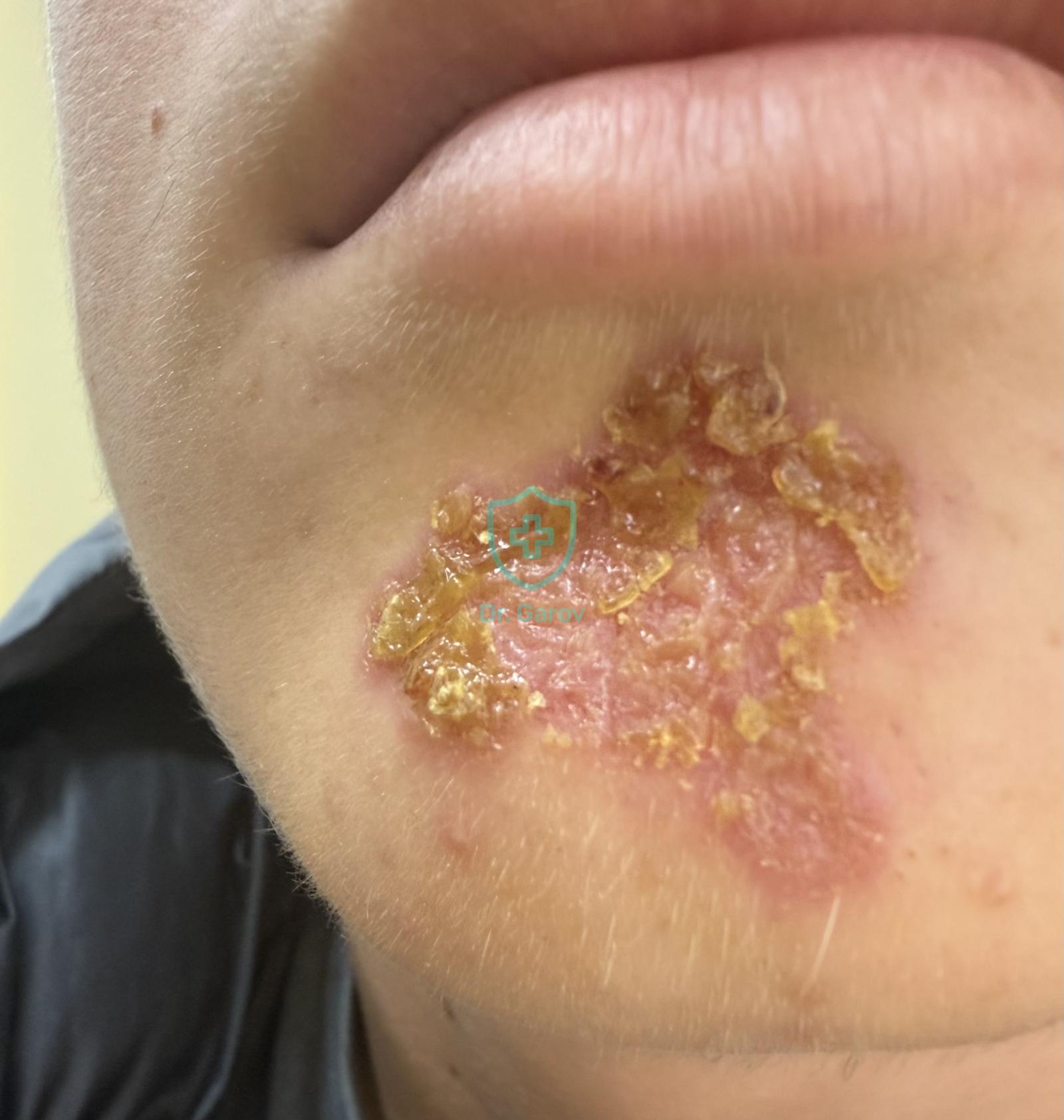 Impetigo contagiosa