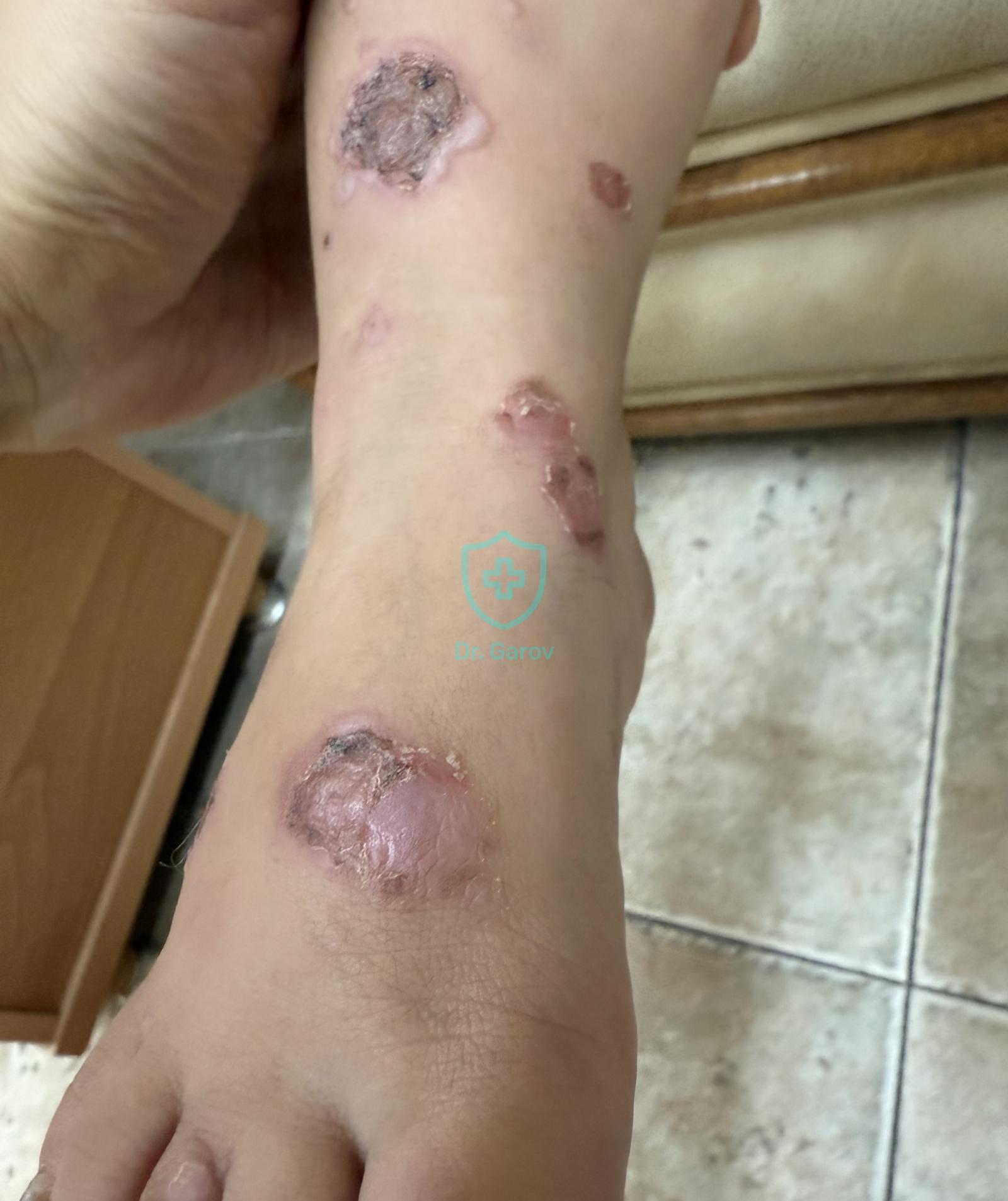 Impetigo contagiosa