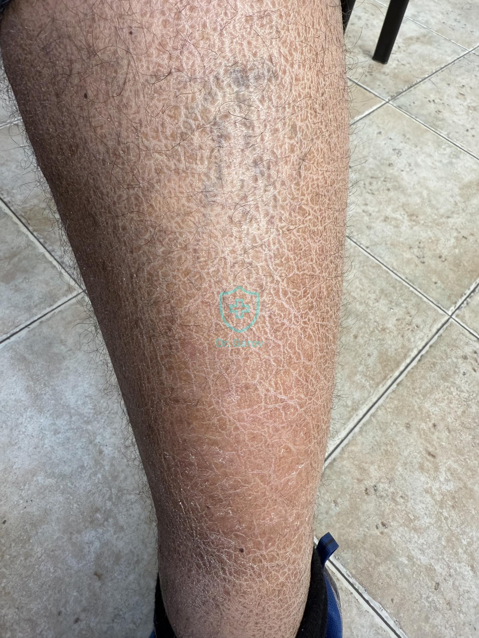Ichthyosis vulgaris