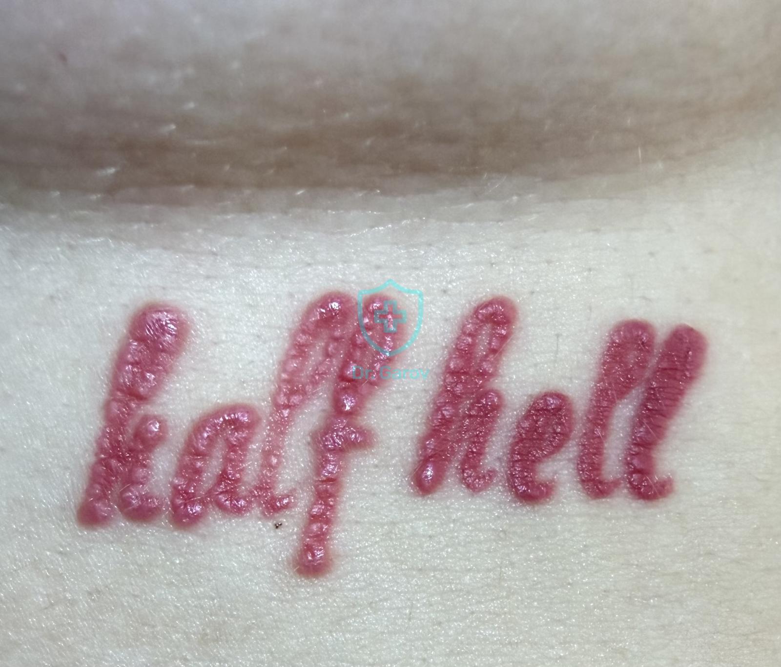 Keloid