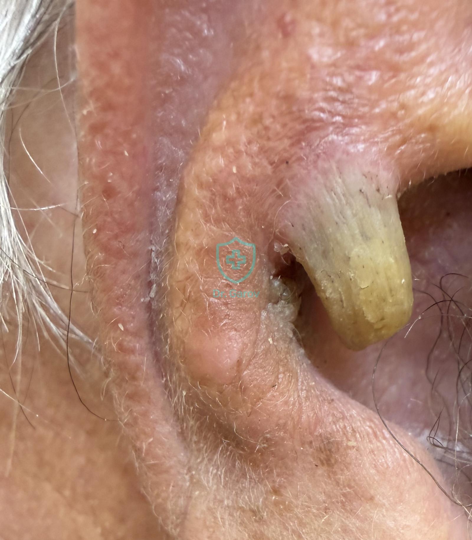 Cornu cutaneum