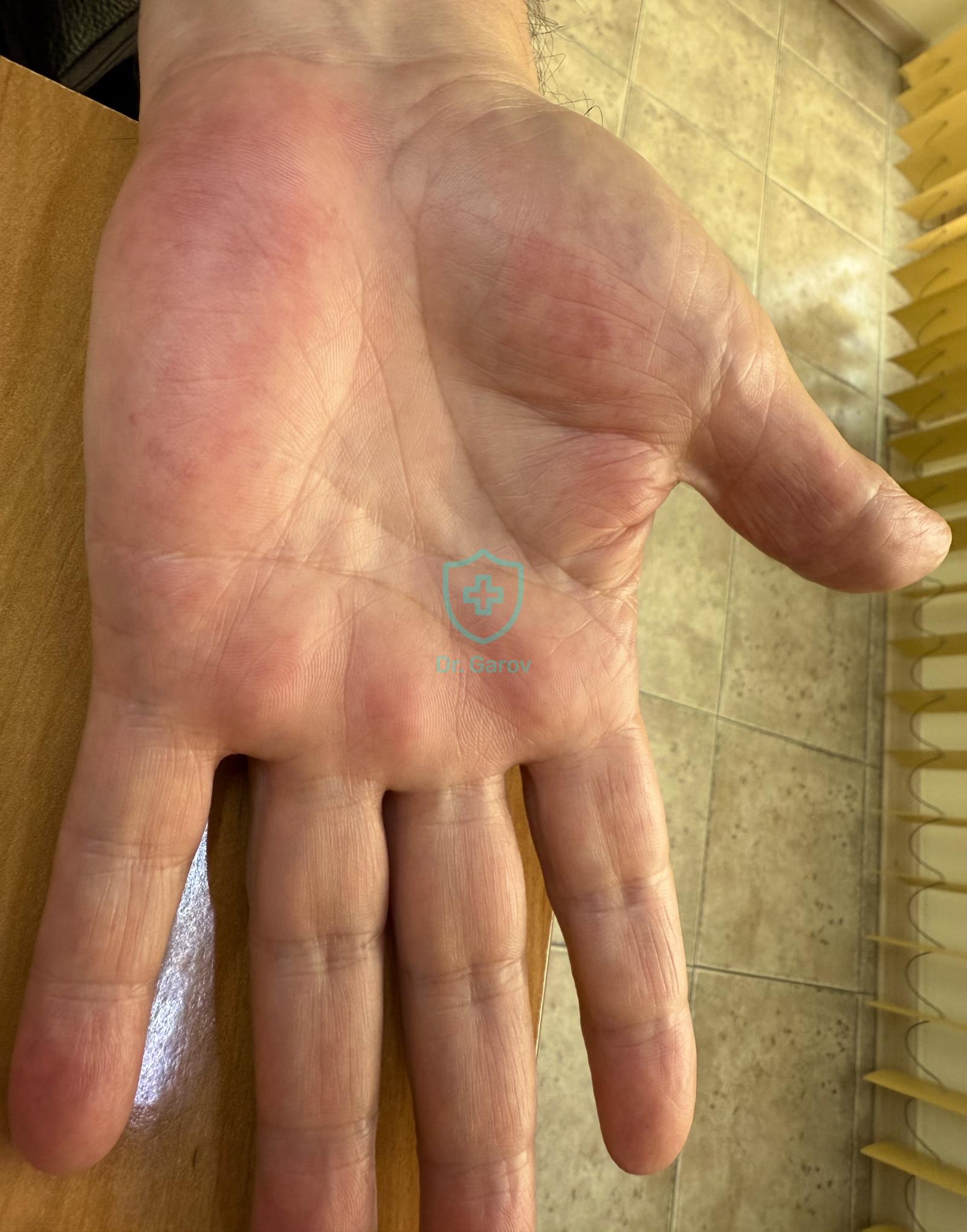 Erythema palmare et plantare