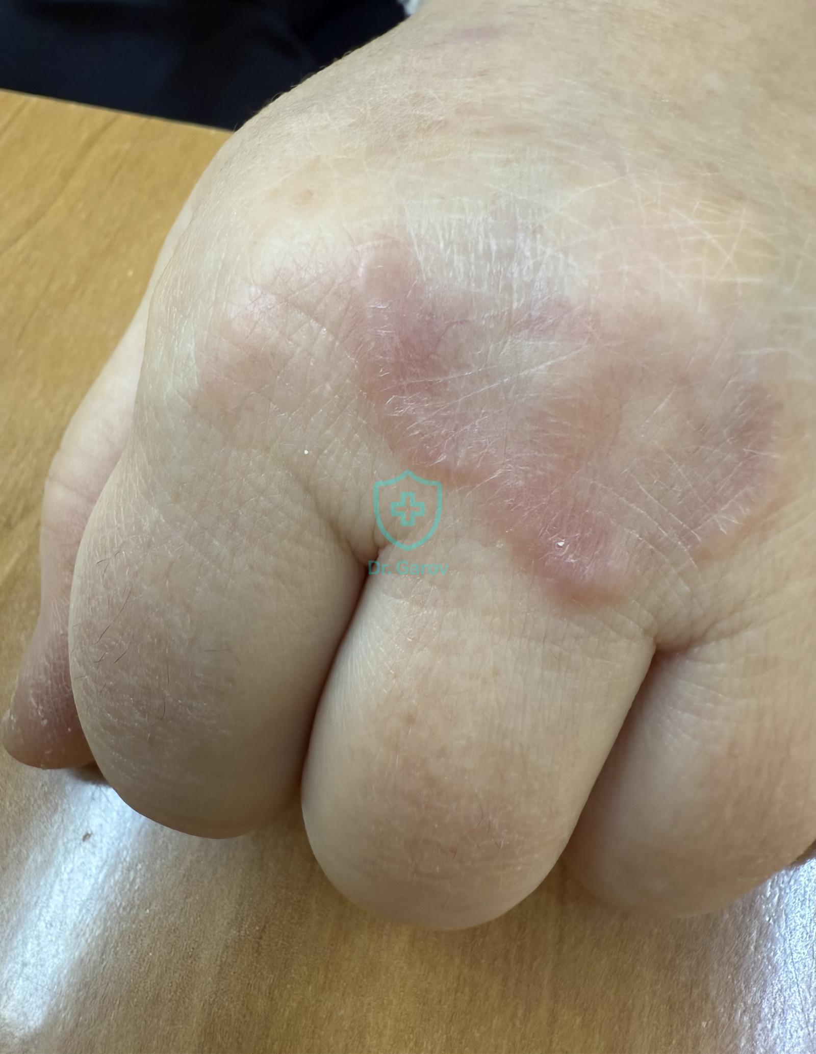 Granuloma annulare при диабет