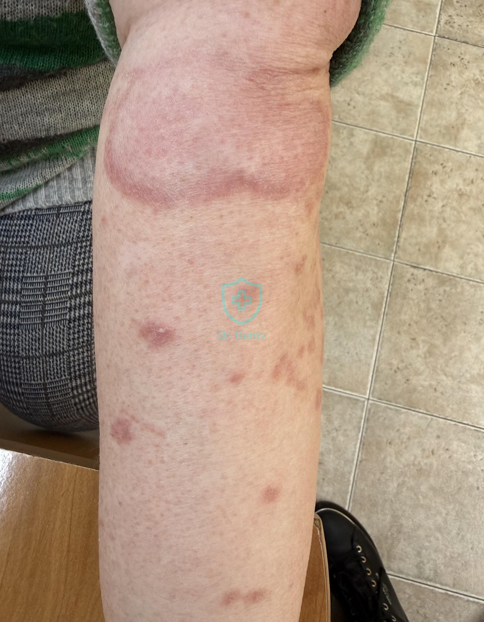 Granuloma annulare при диабет