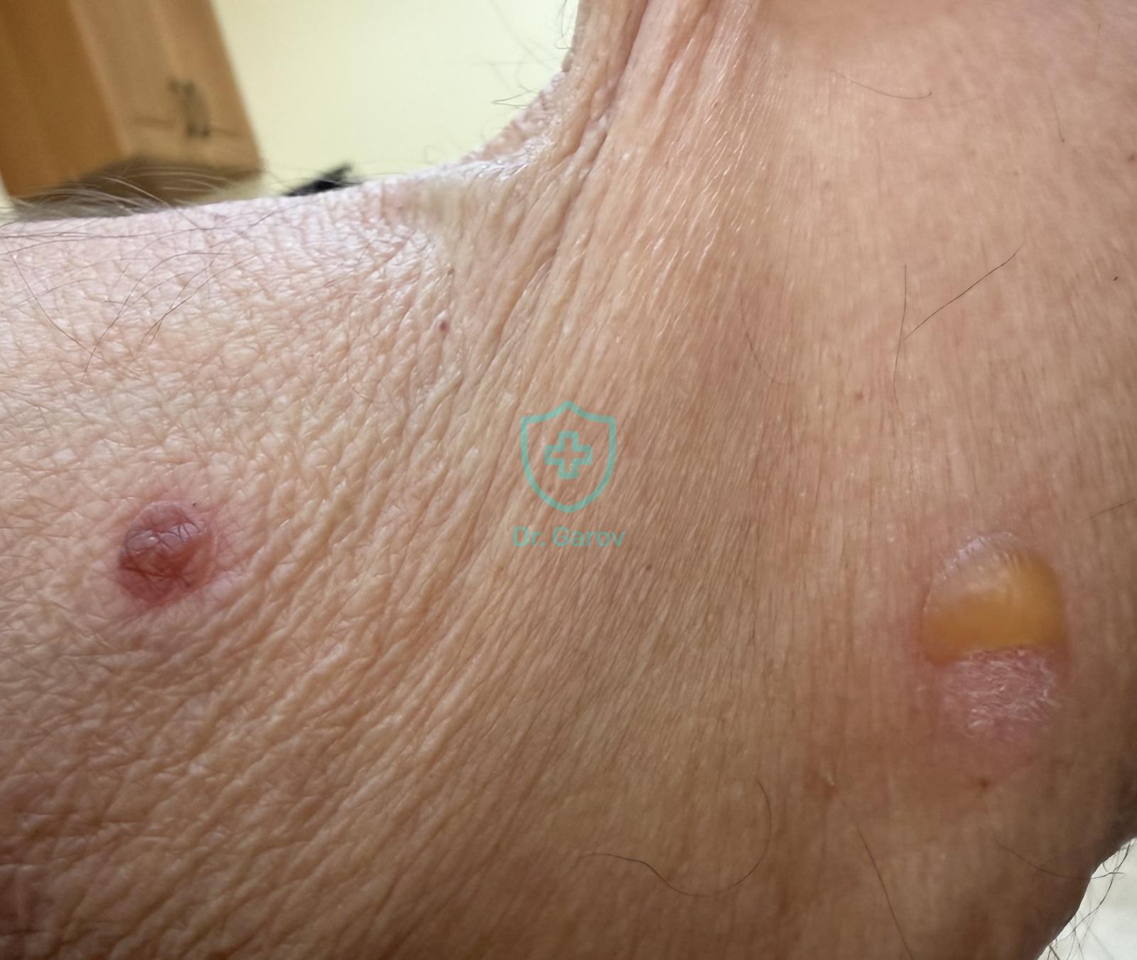 Paraneoplastic pemphigus