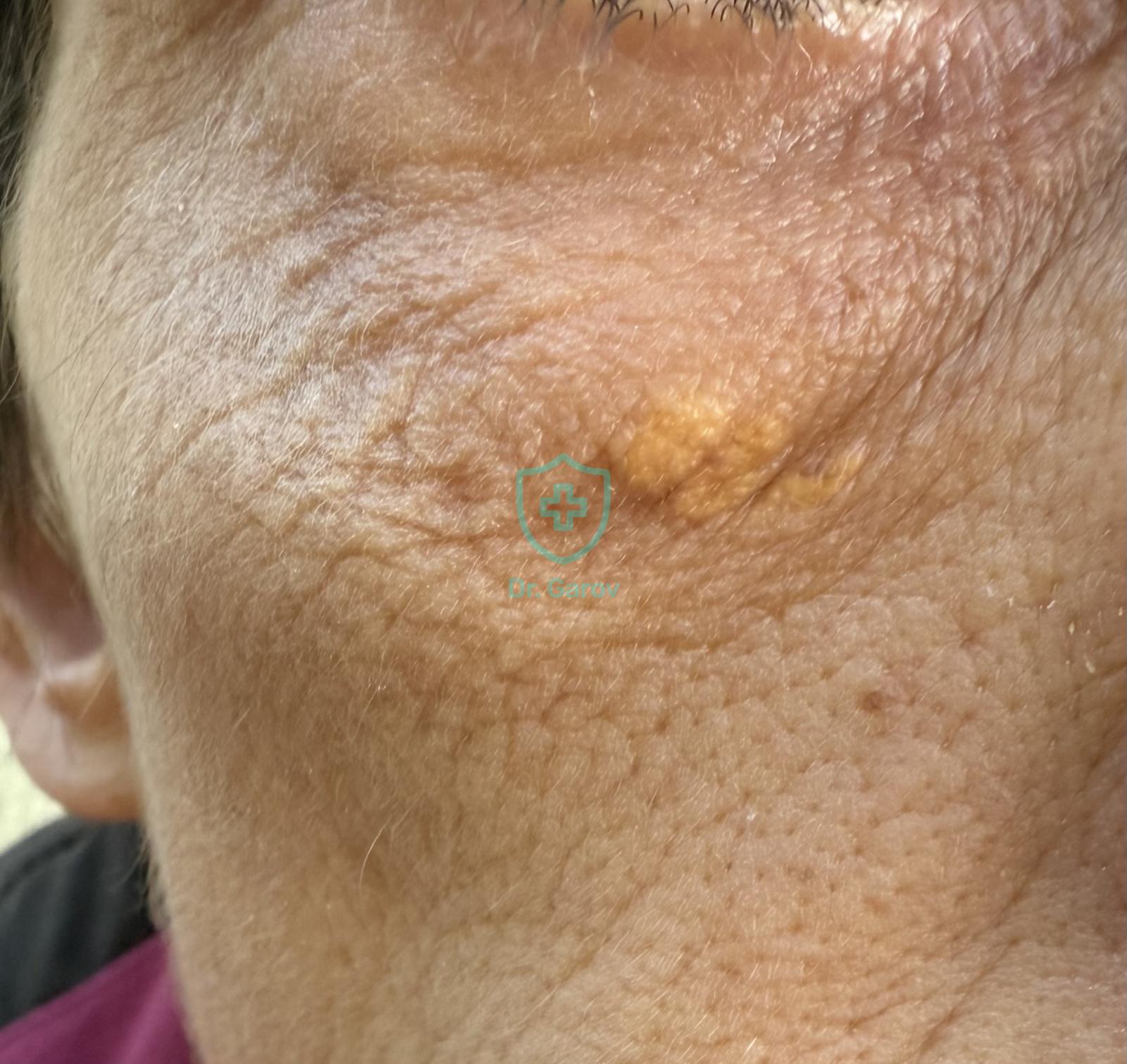 Xanthelasma