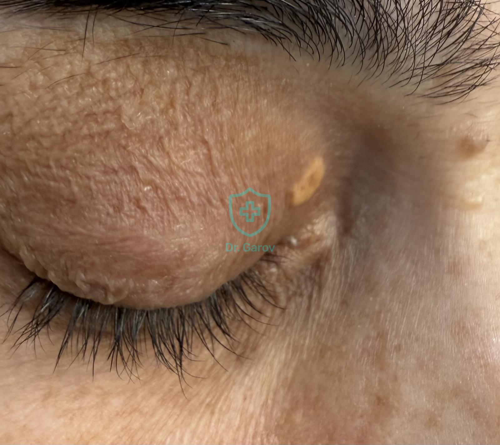 Xanthelasma