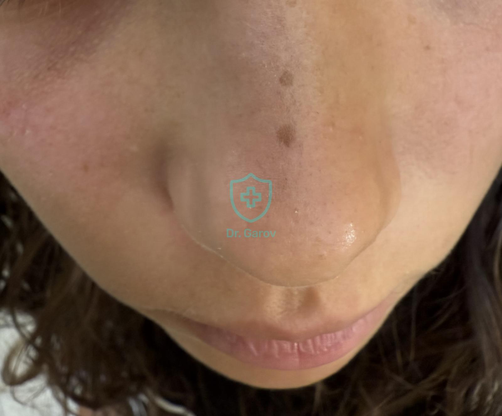 Lentigo simplex