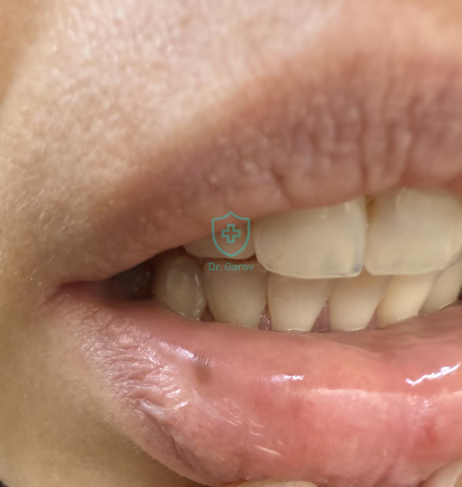 Mucosal melanosis