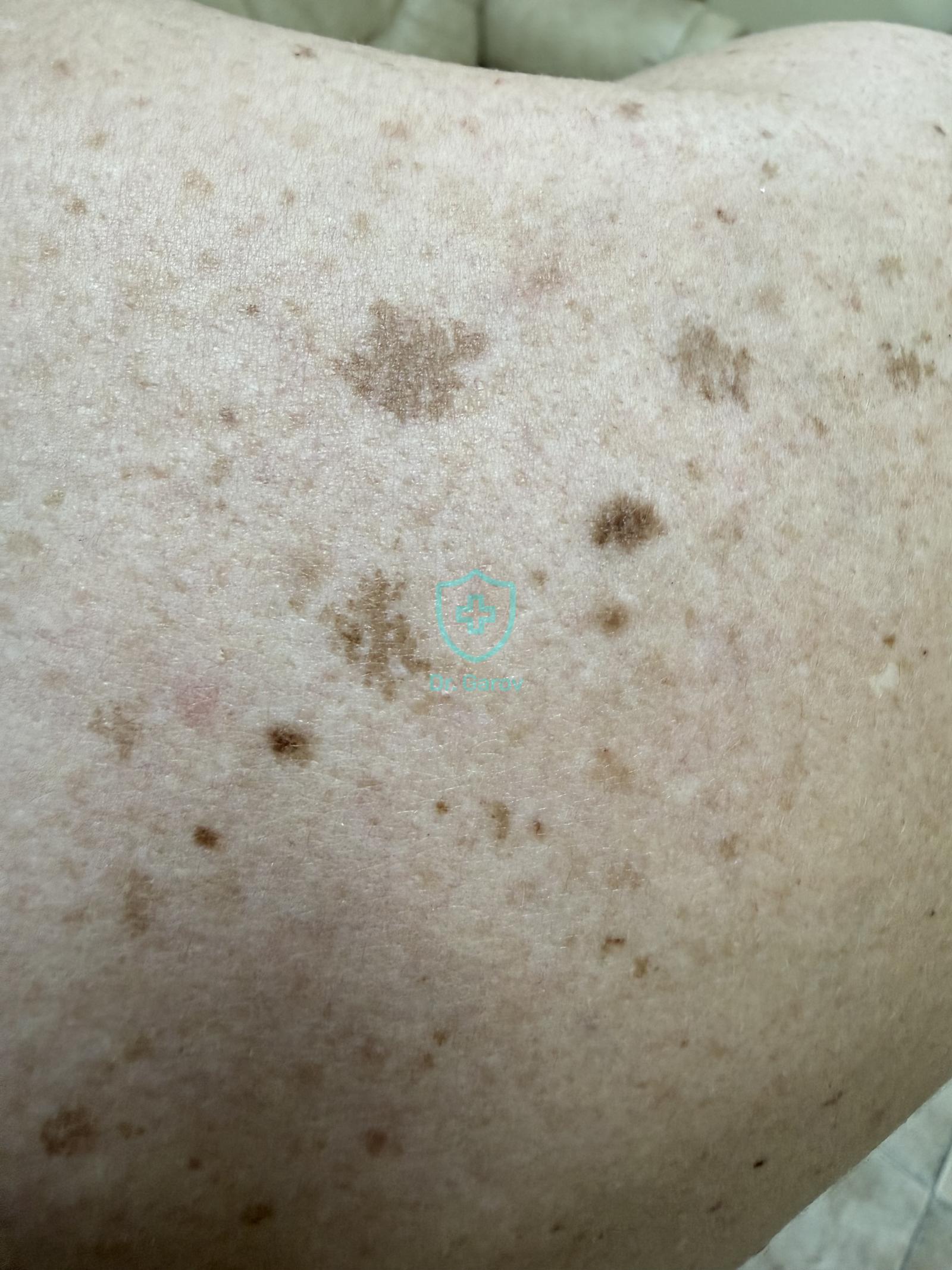 Lentigo solaris