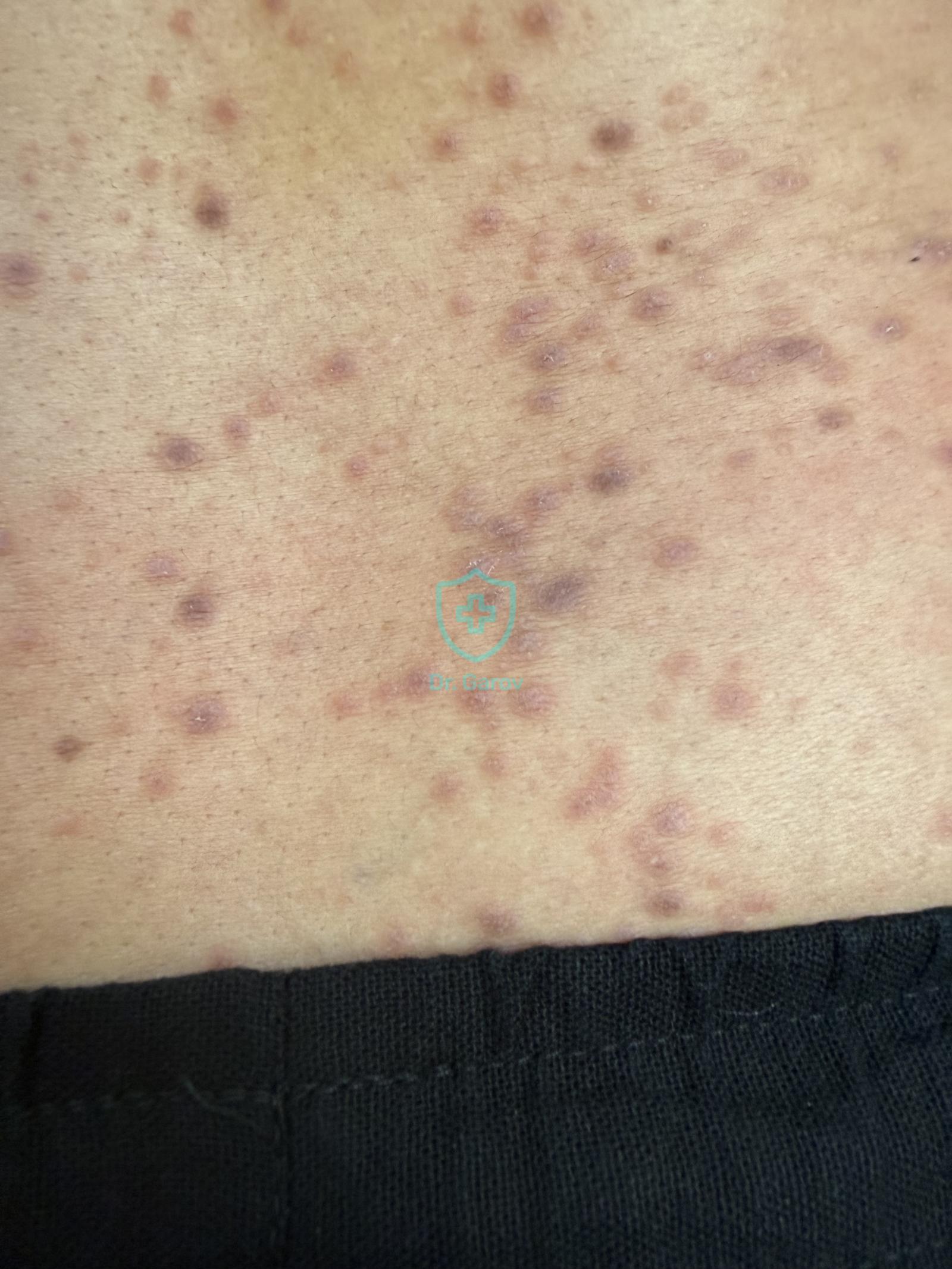 Lichen planus