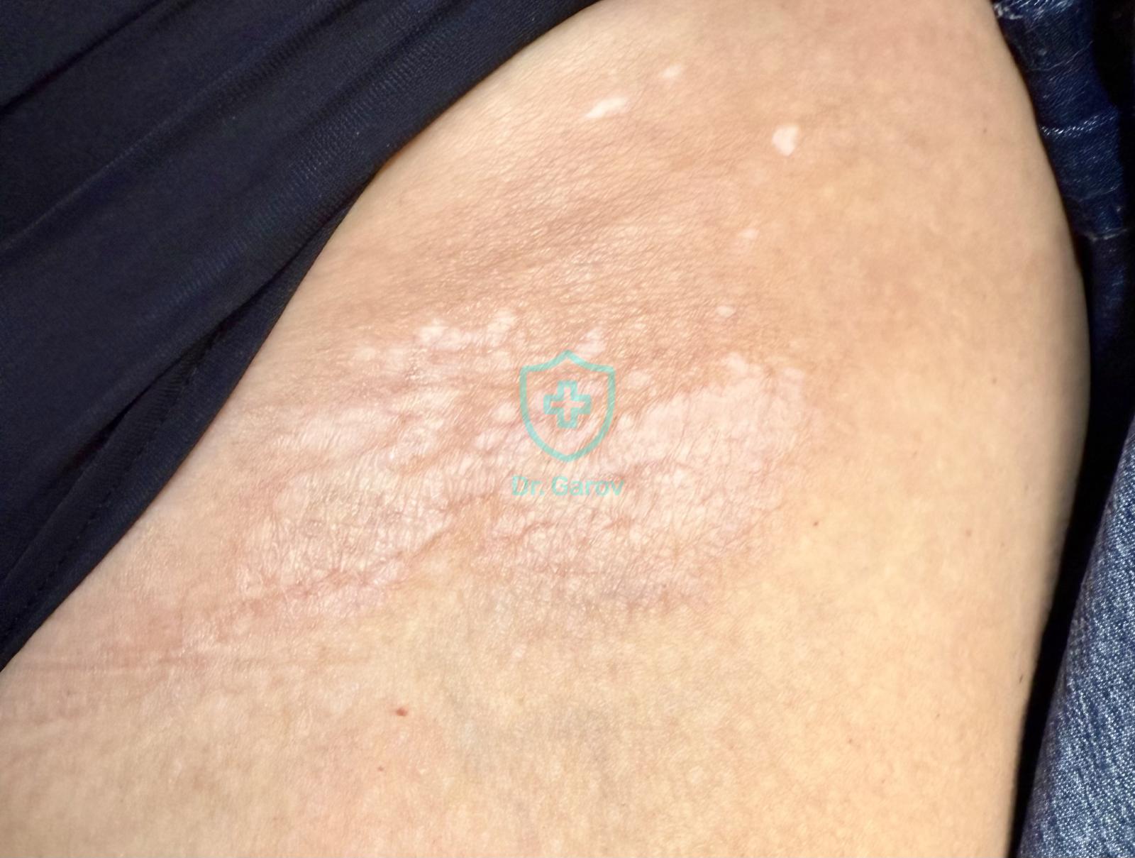 Lichen sclerosus - екстрагенитална локализация