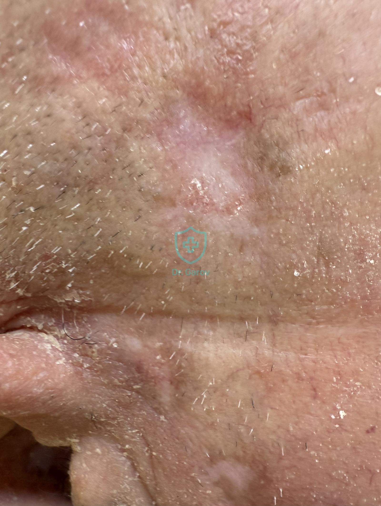 Lupus erythematosus chronicus dyscoides
