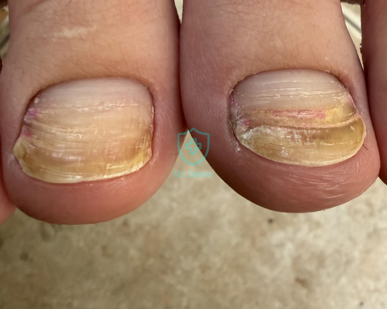 Onychomycosis
