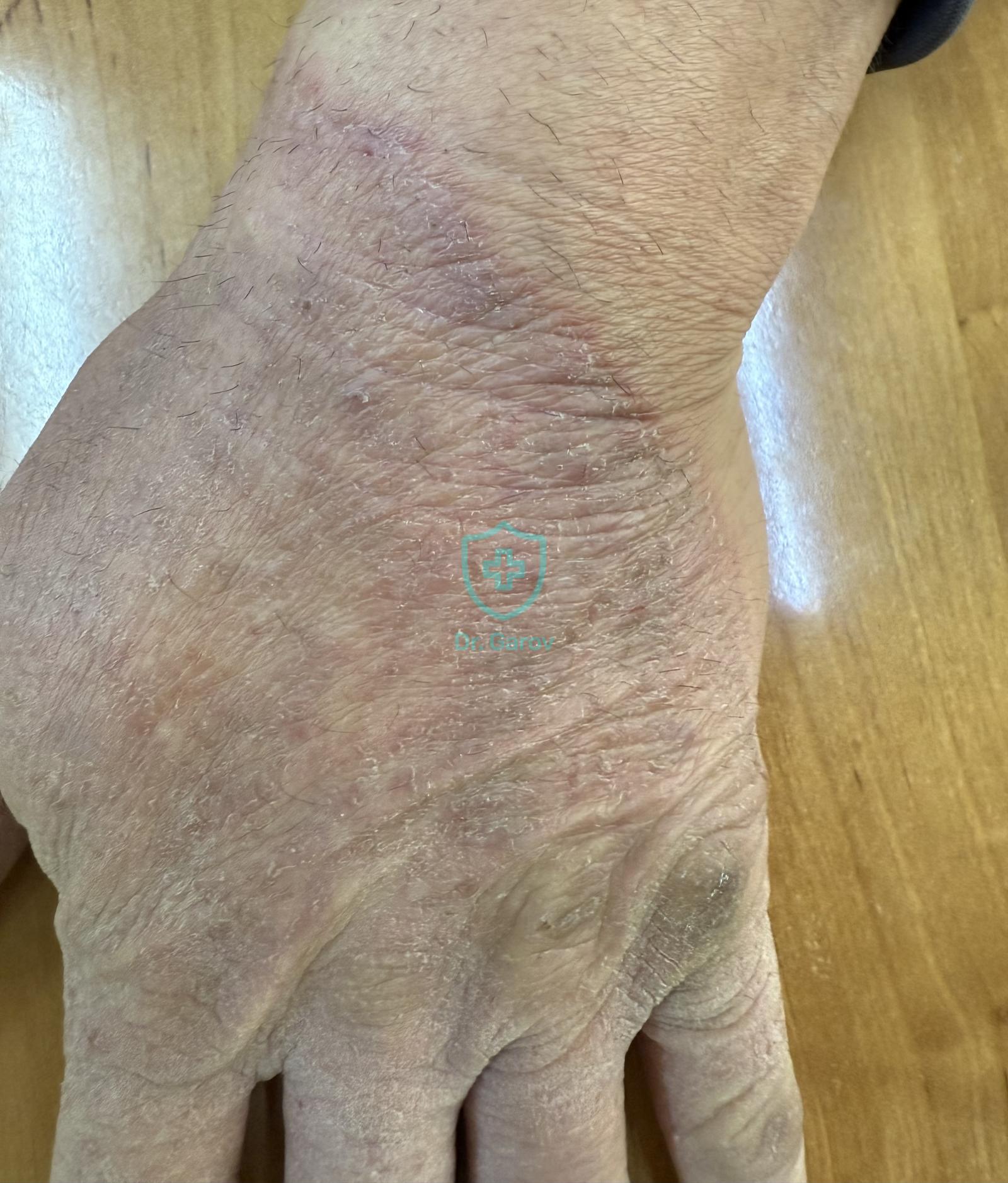 Tinea manum, Epidermophytia manum
