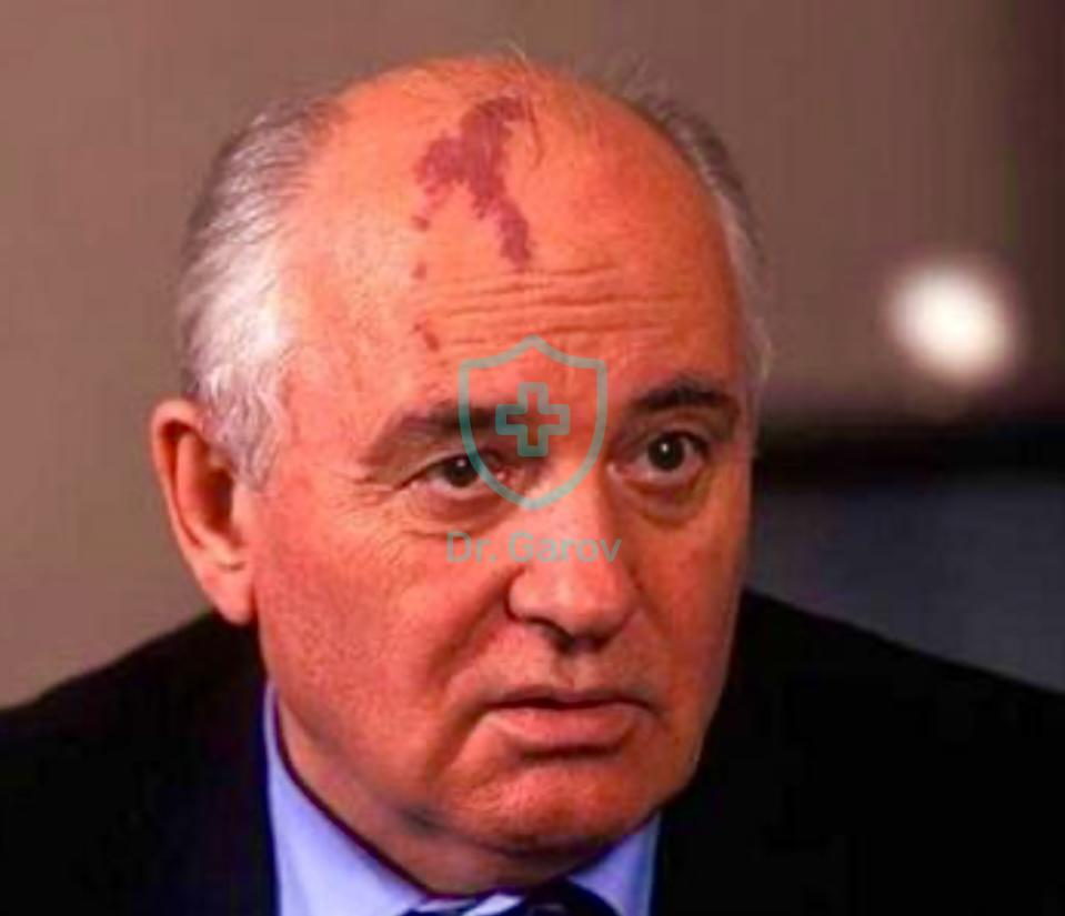 Снимка към статия Невус фламеус