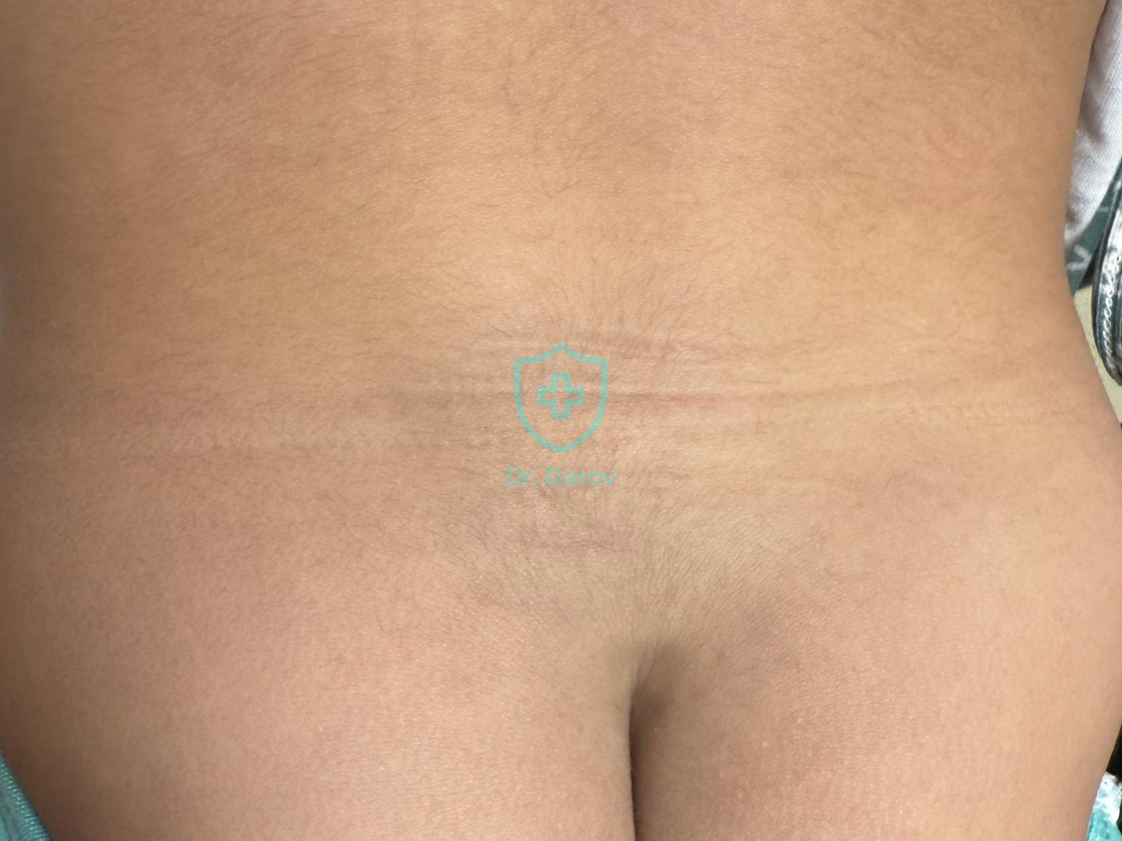 Macula mongoliana