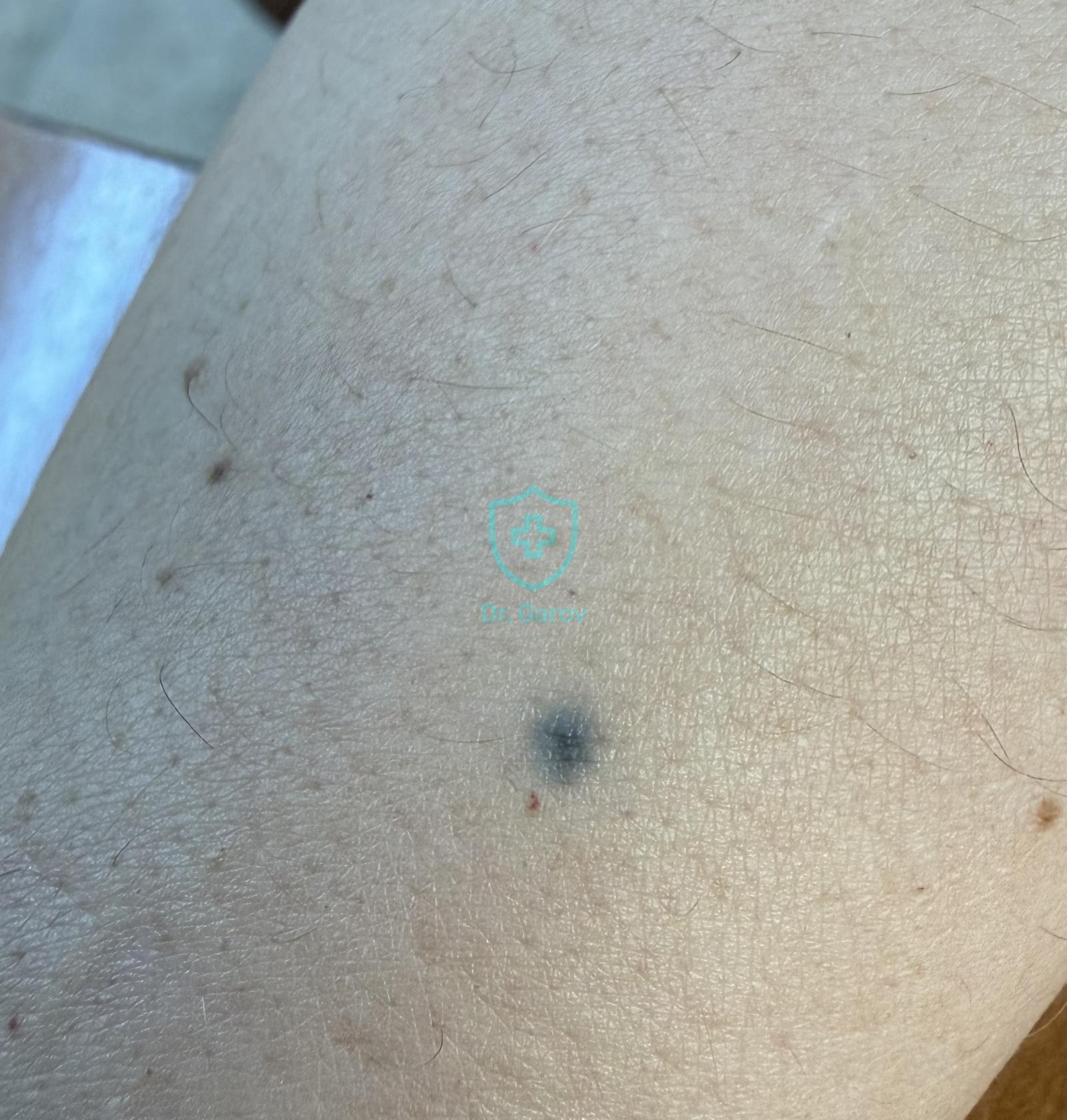 Blue nevus