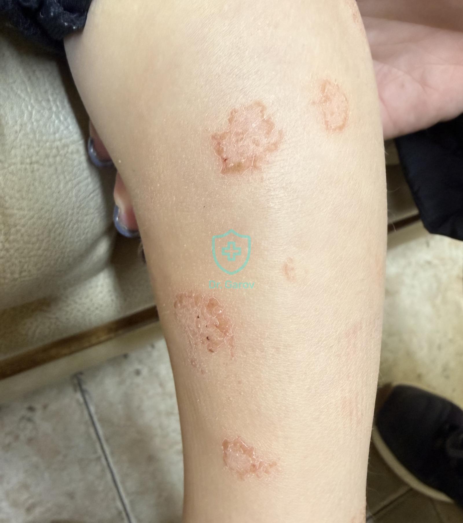 Eczema nummulare