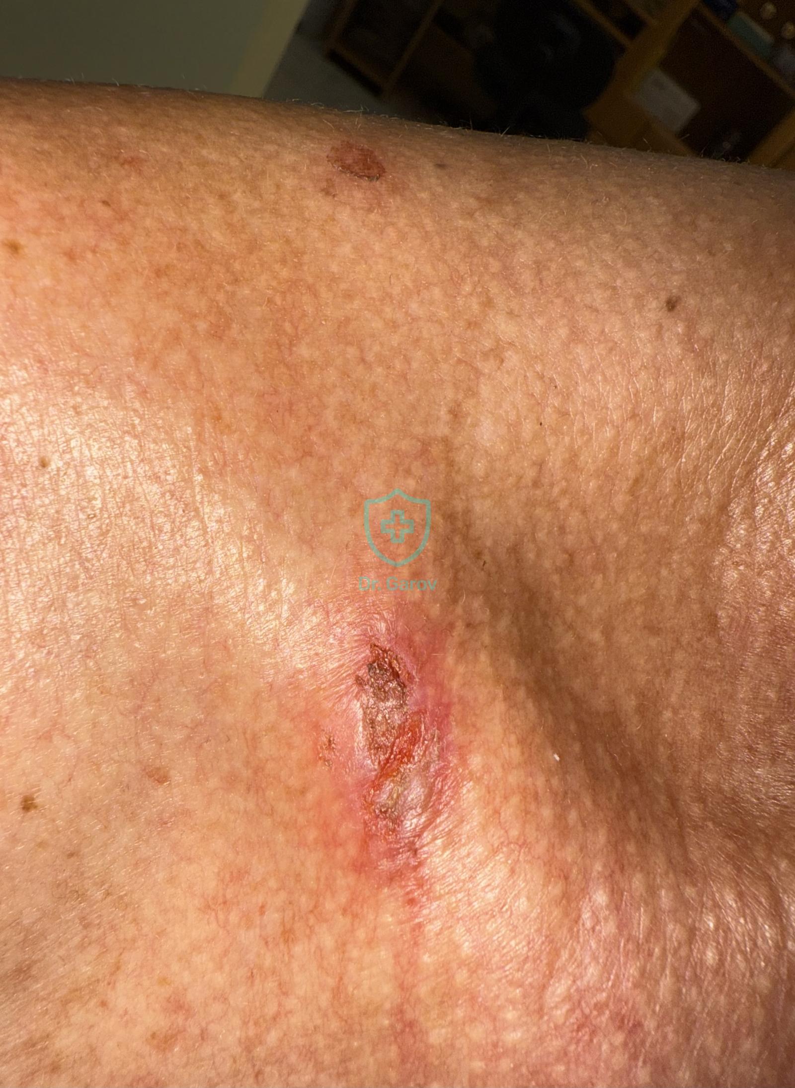 Pemphigus erythematosus (seborrhoicus)