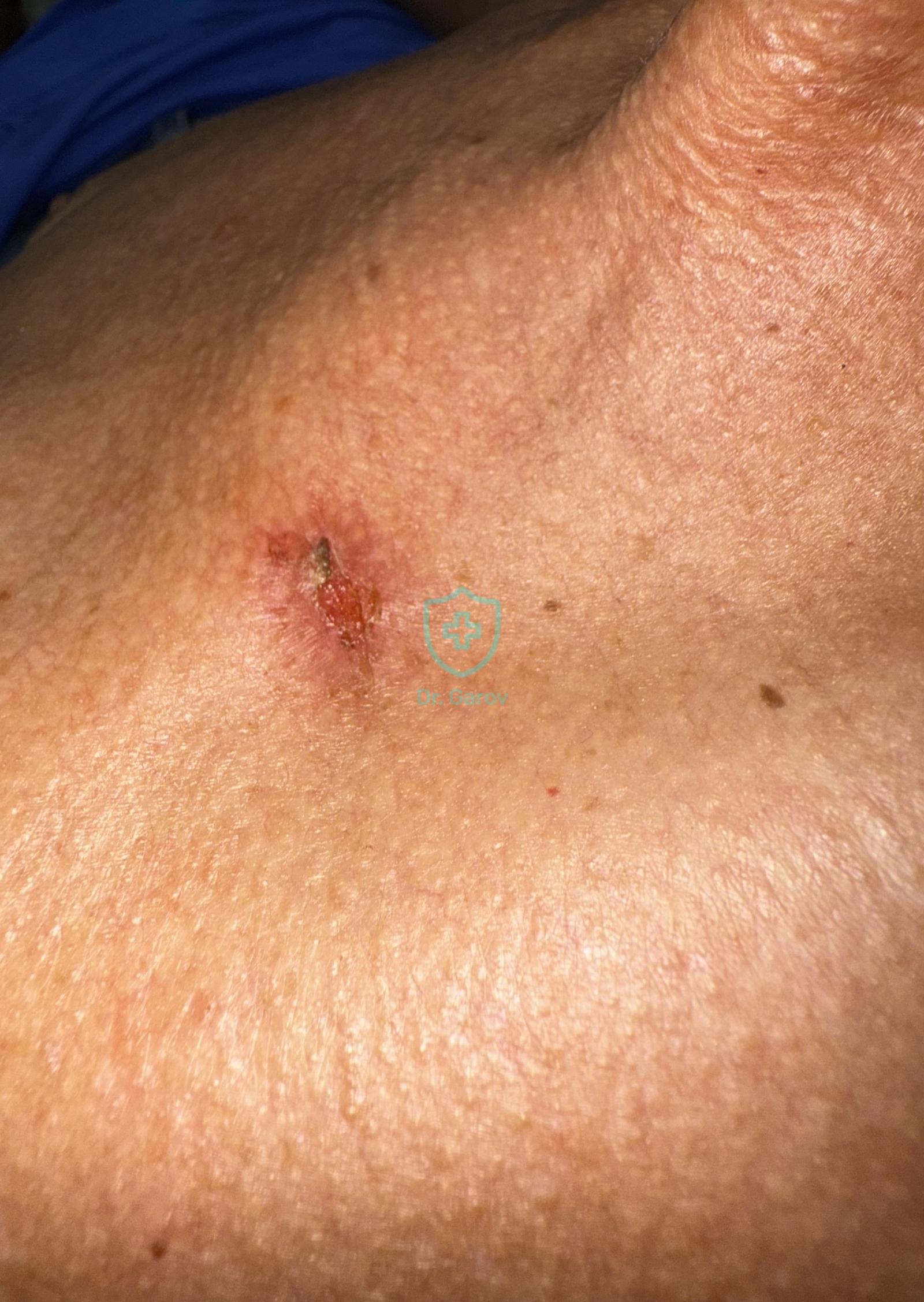 Pemphigus erythematosus (seborrhoicus)