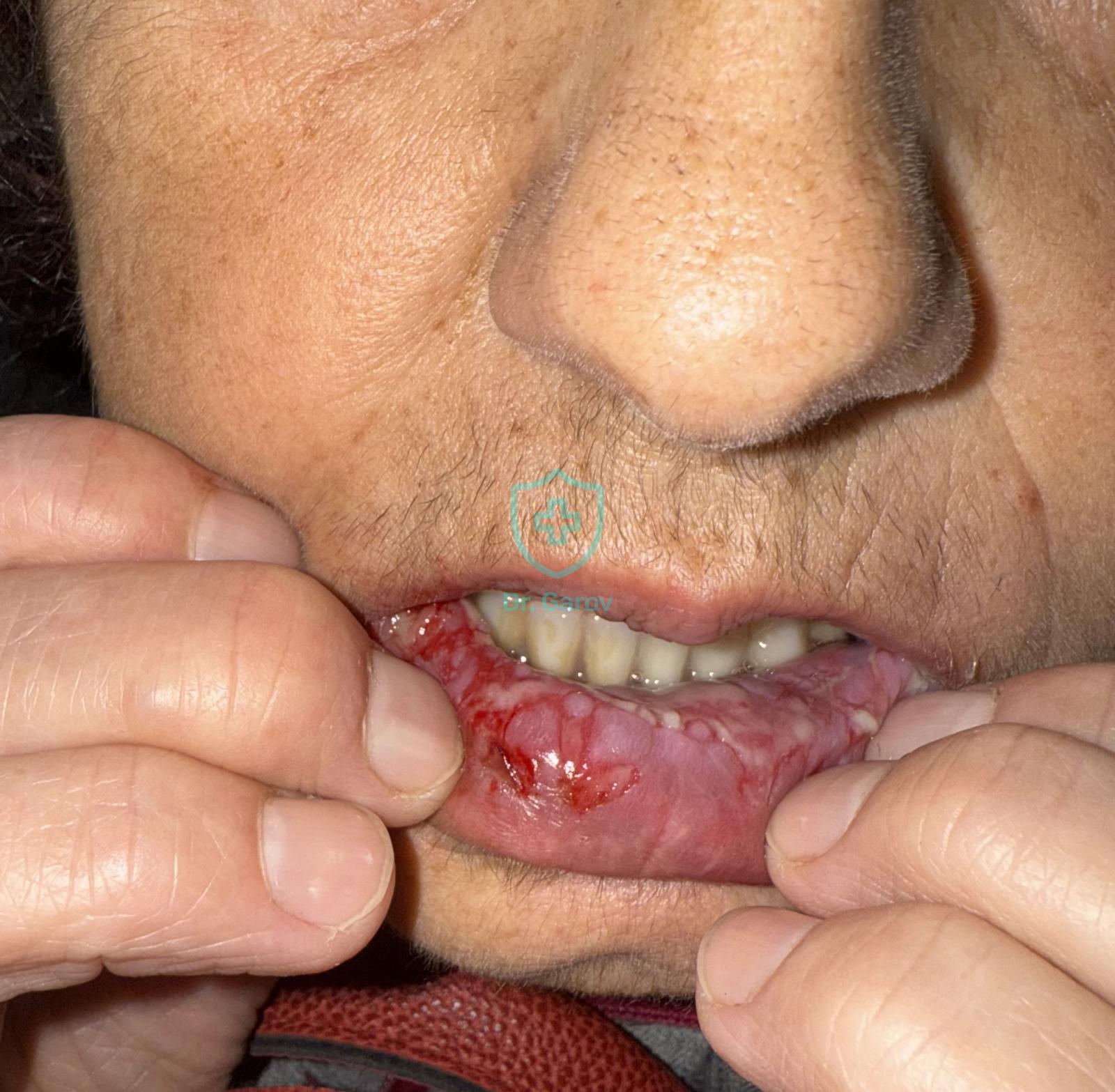 Pemphigus vulgaris