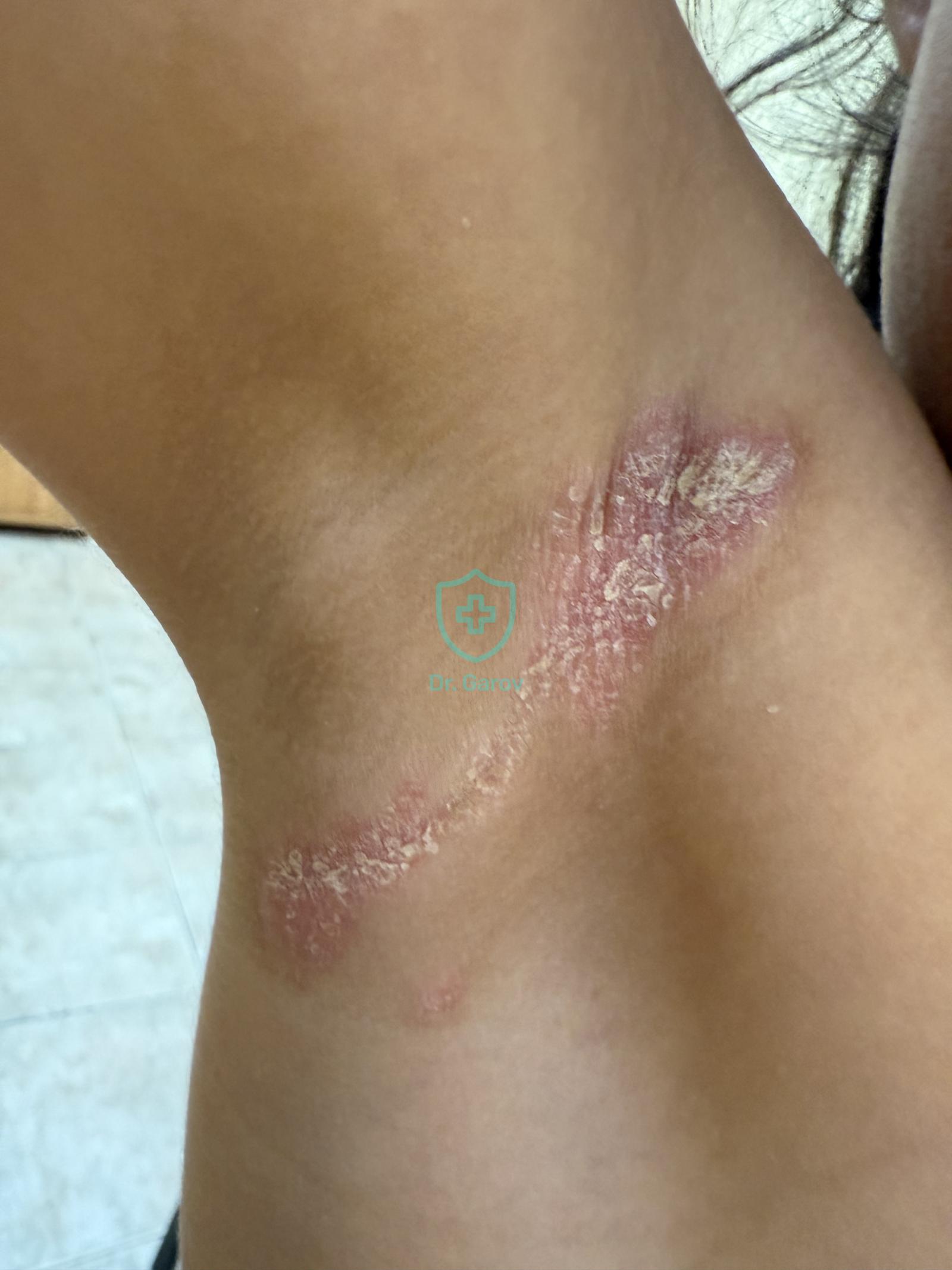 Psoriasis inverta