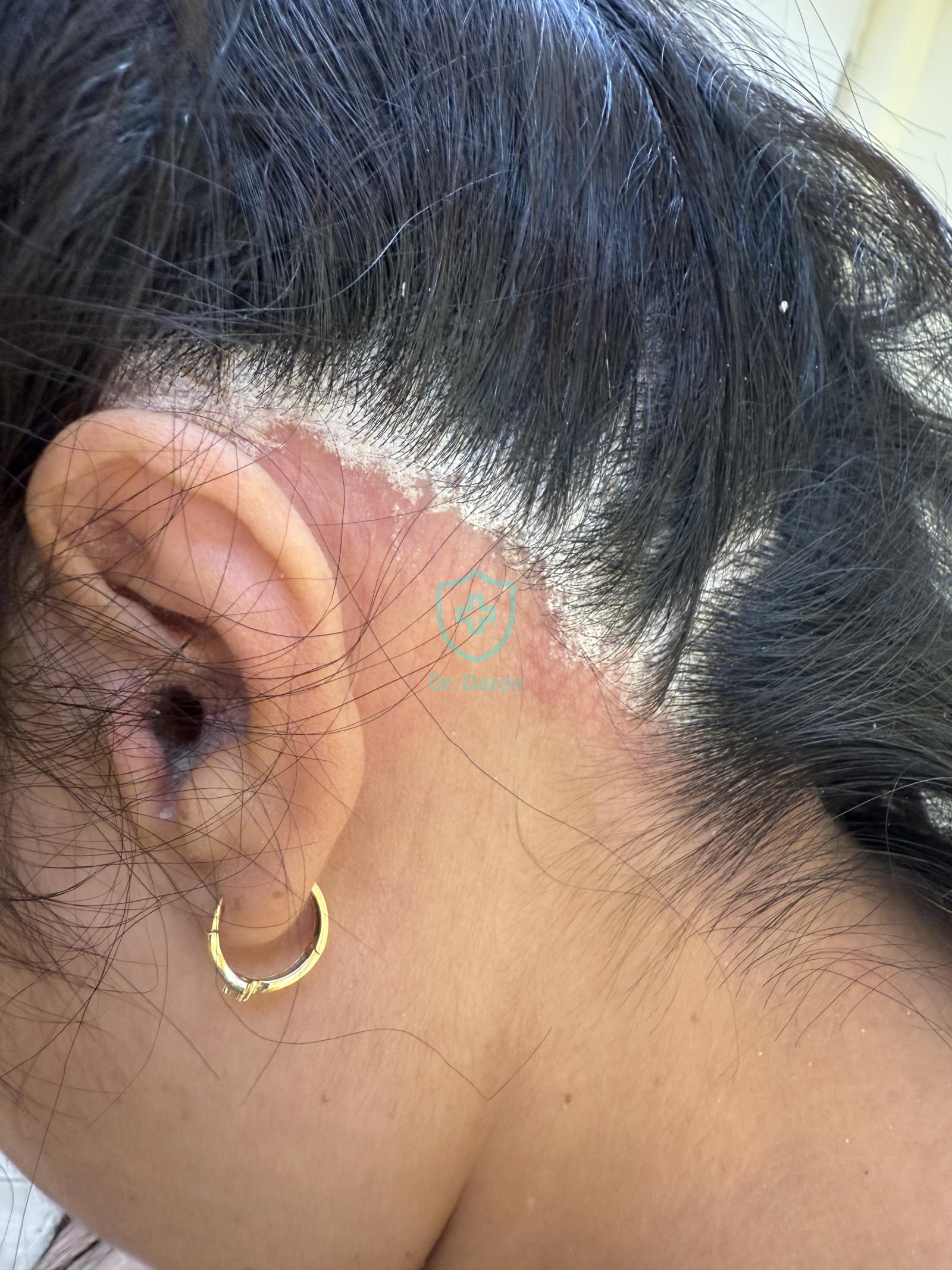 Psoriasis vulgaris capillitii