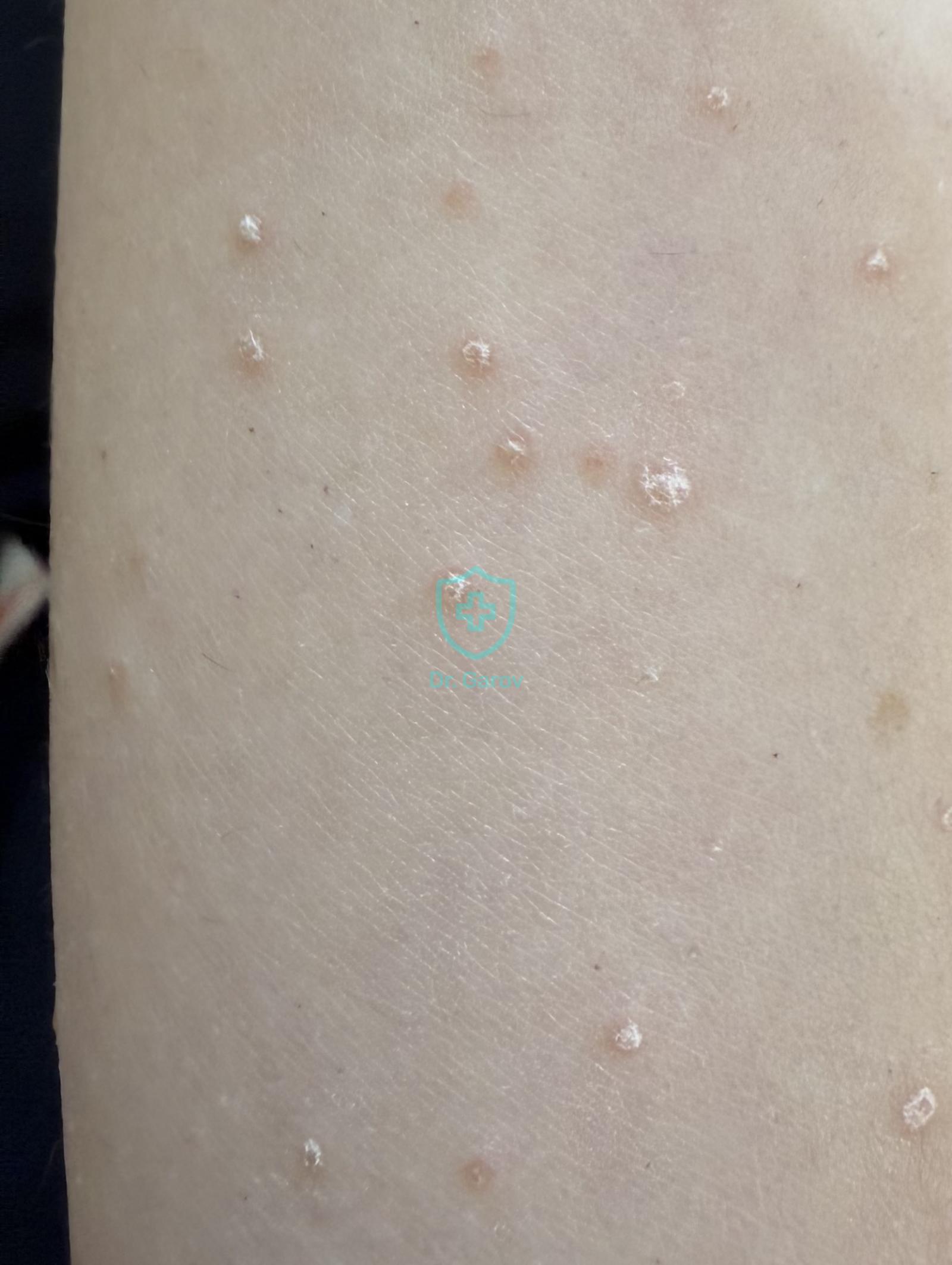 Psoriasis punctata