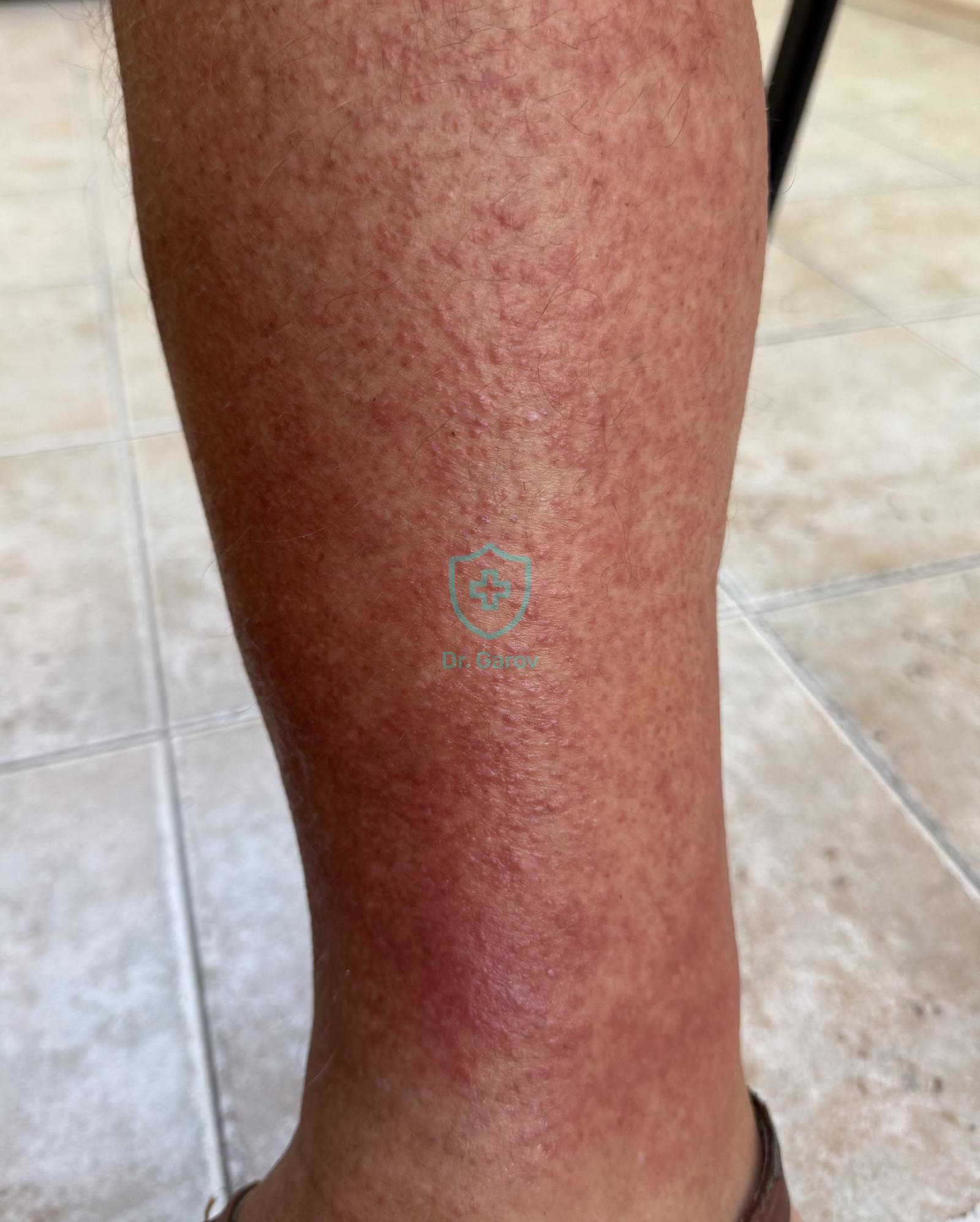Exercise-induced capillaritis