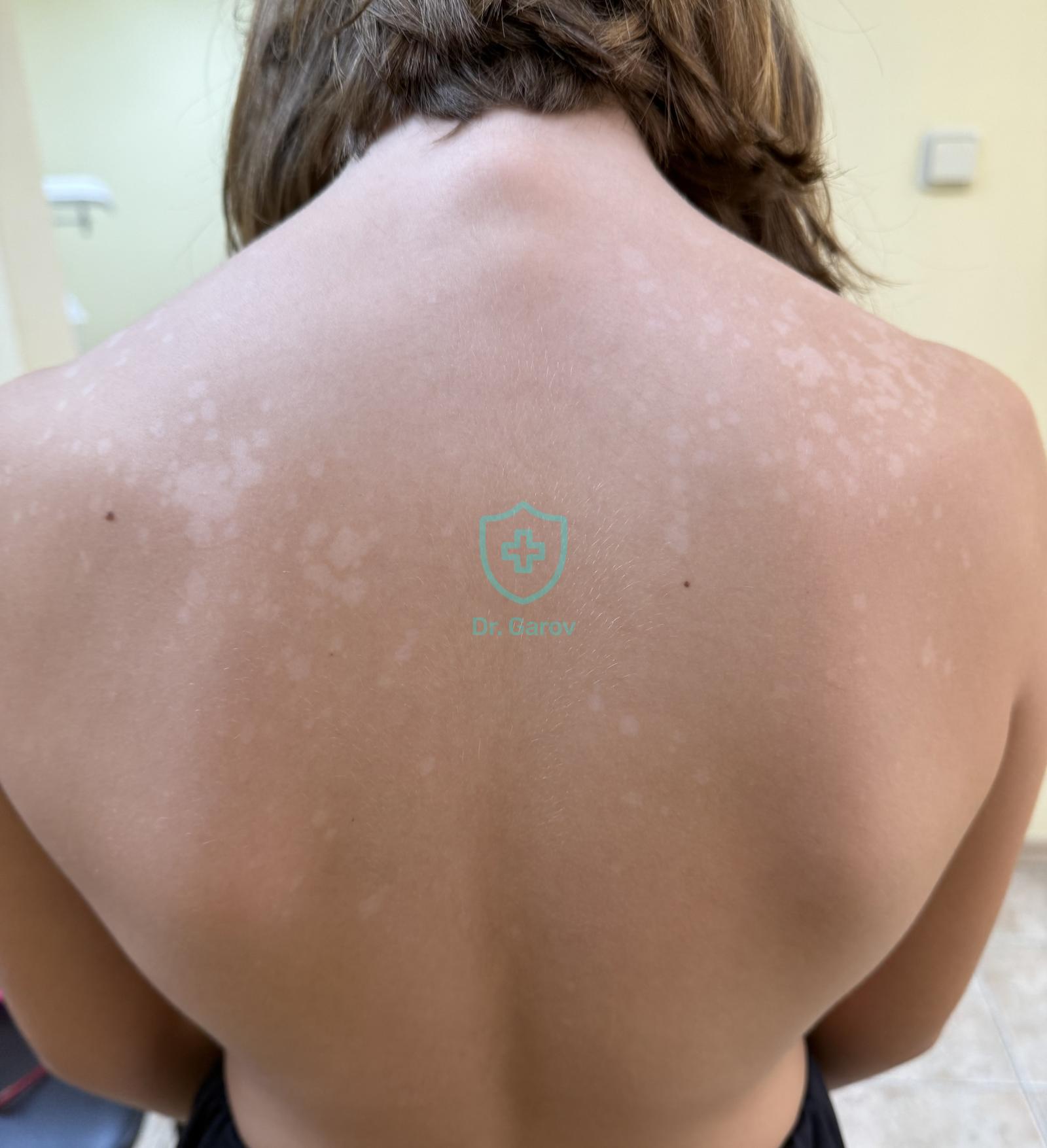 Pityriasis versicolor alba