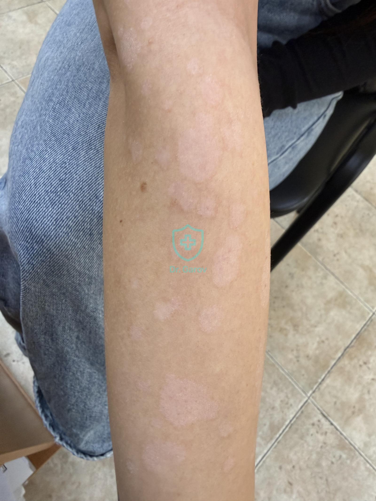 Pityriasis versicolor