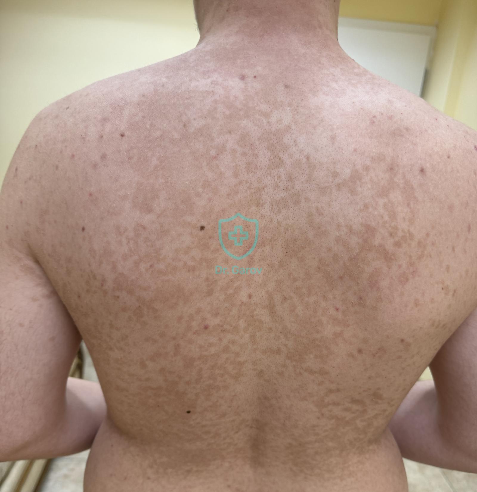 Pityriasis versicolor