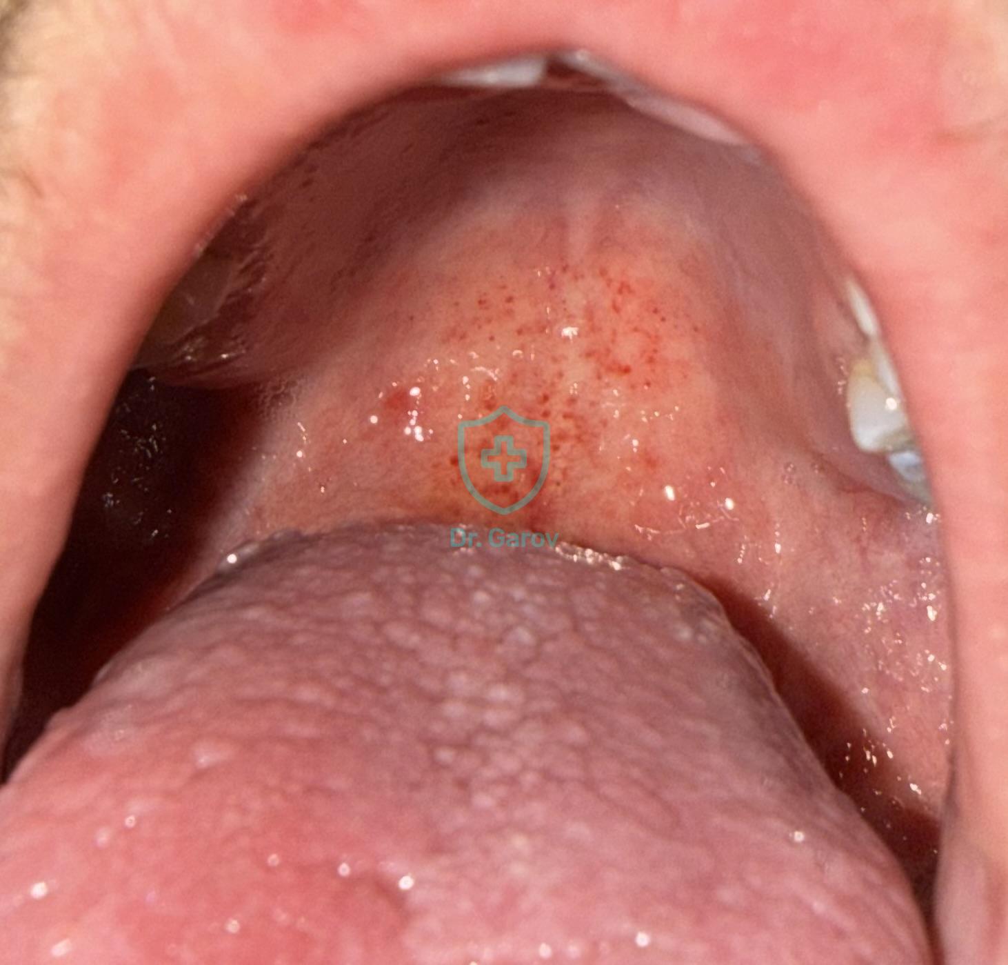 Hand, foot, and mouth disease