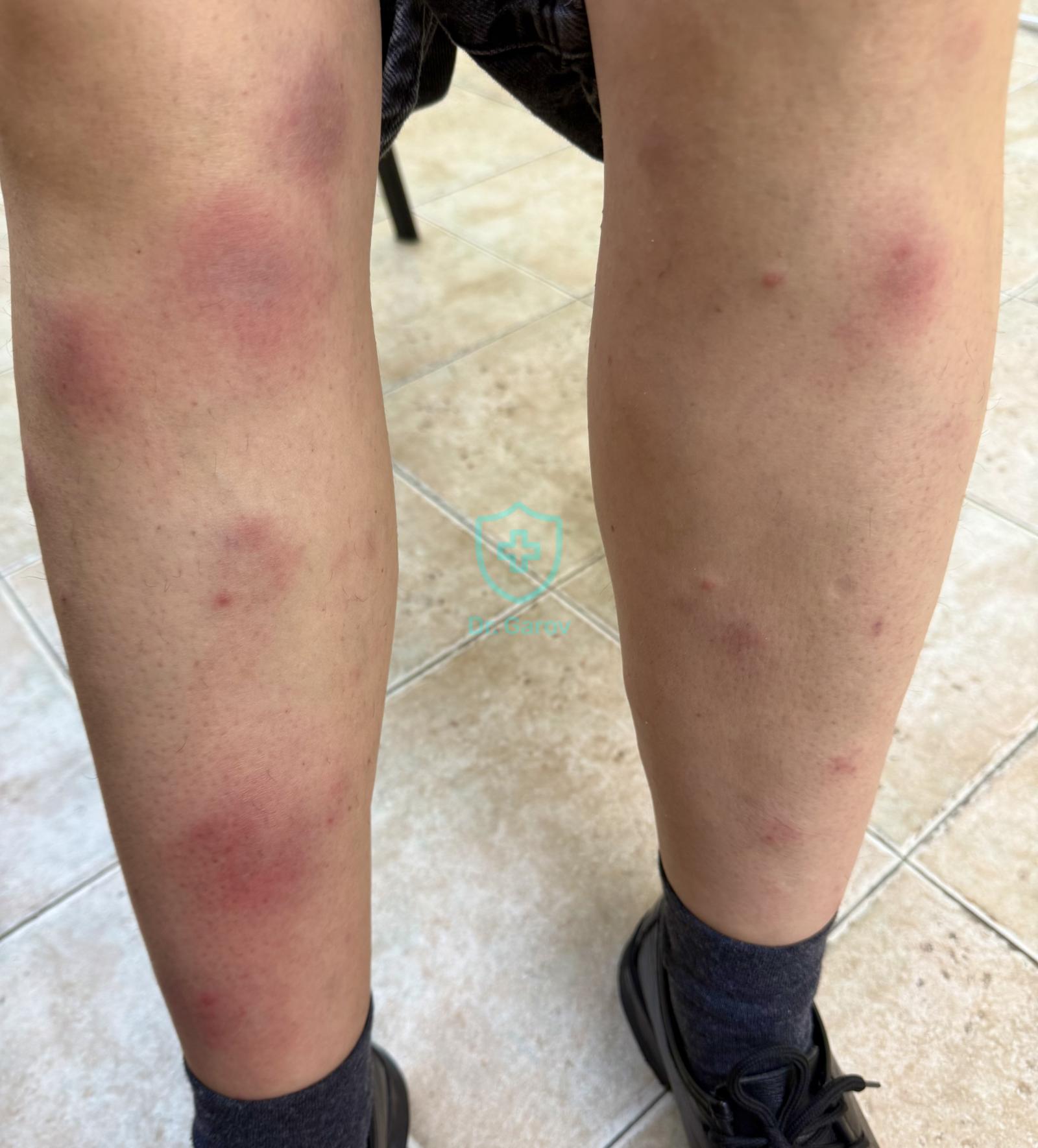 Erythema nodosum