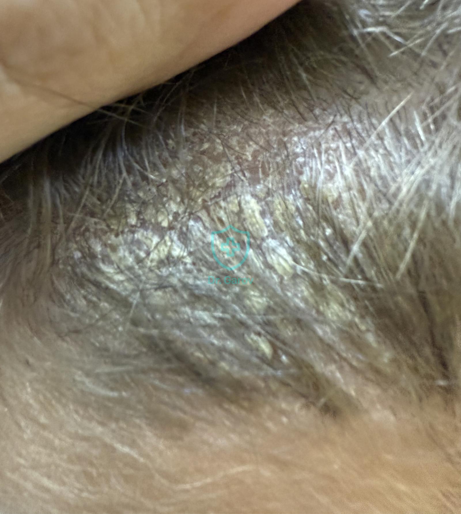 Dermatitis seborrhoides - Pseudotinea amiantacea
