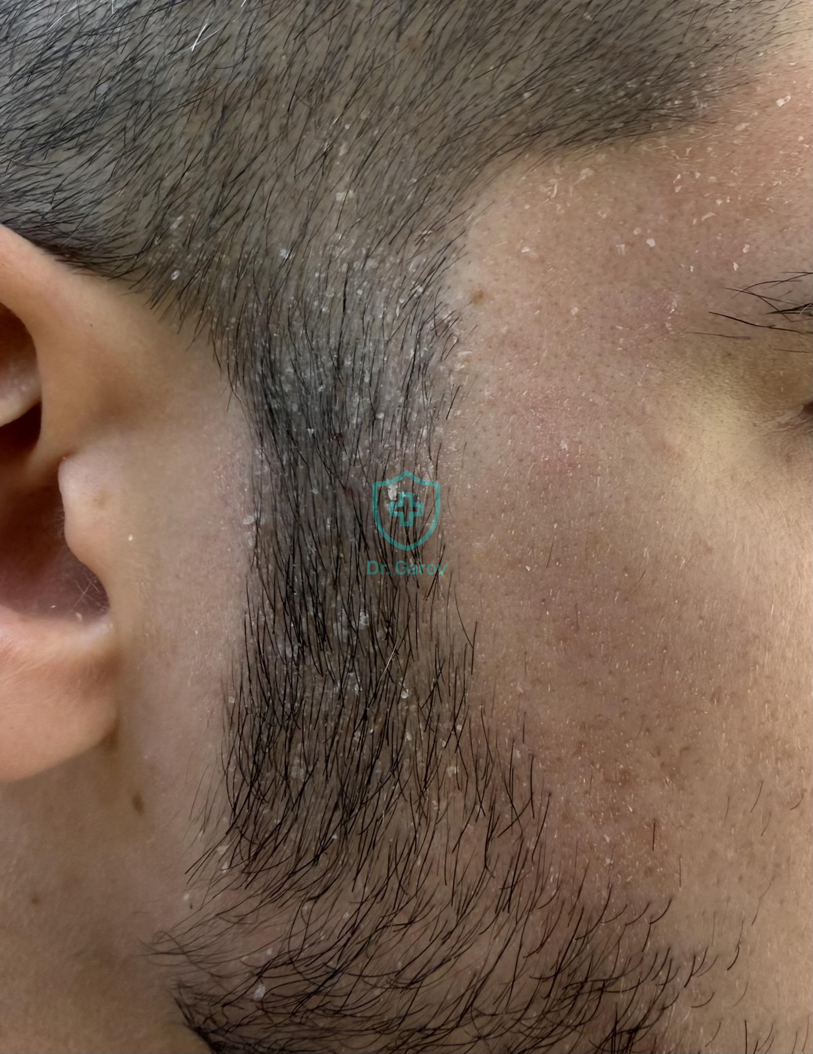 Dermatitis seborrhoides