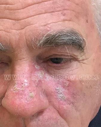 Снимка Сенилни кератоми