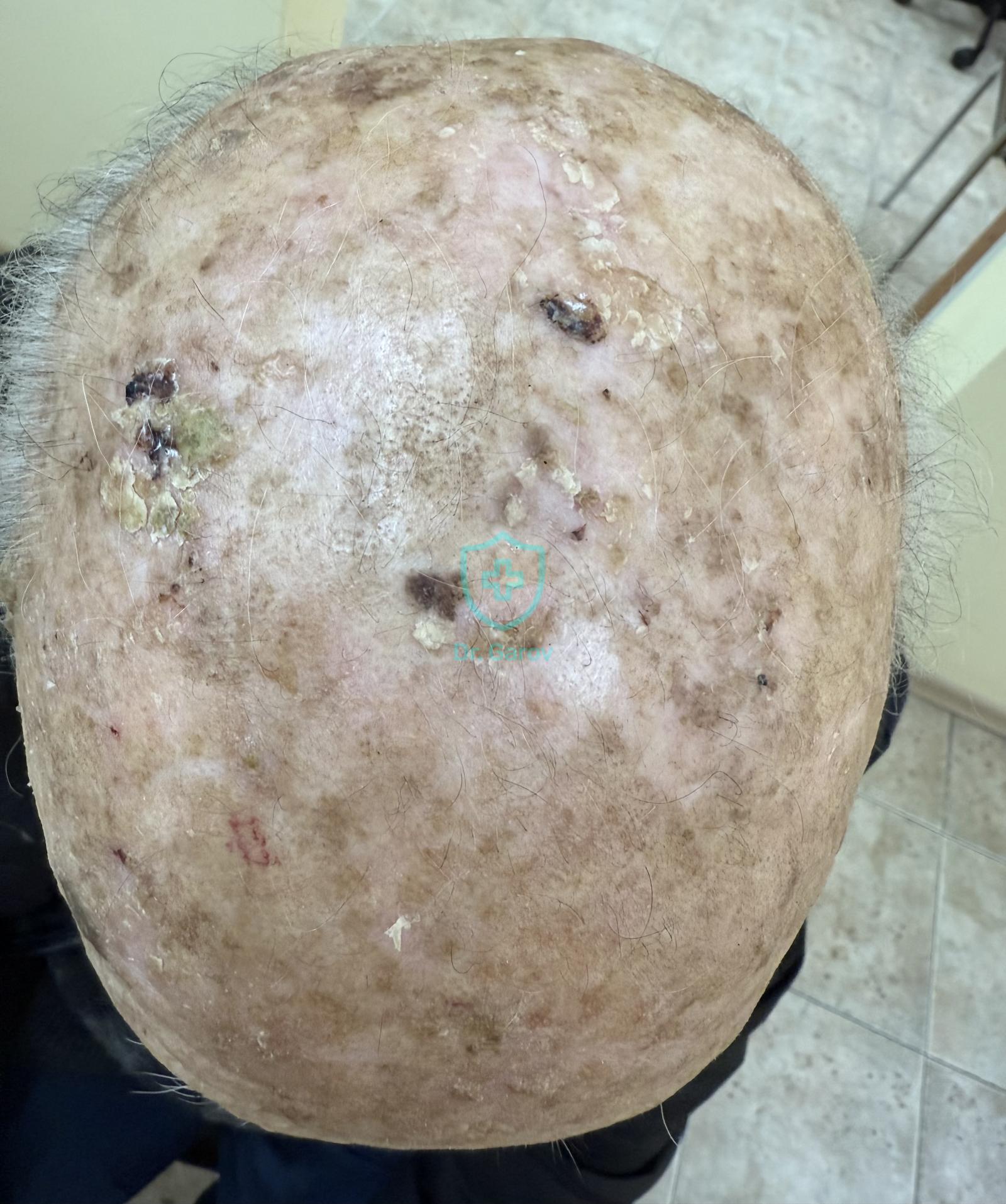 Keratoma senile, solare