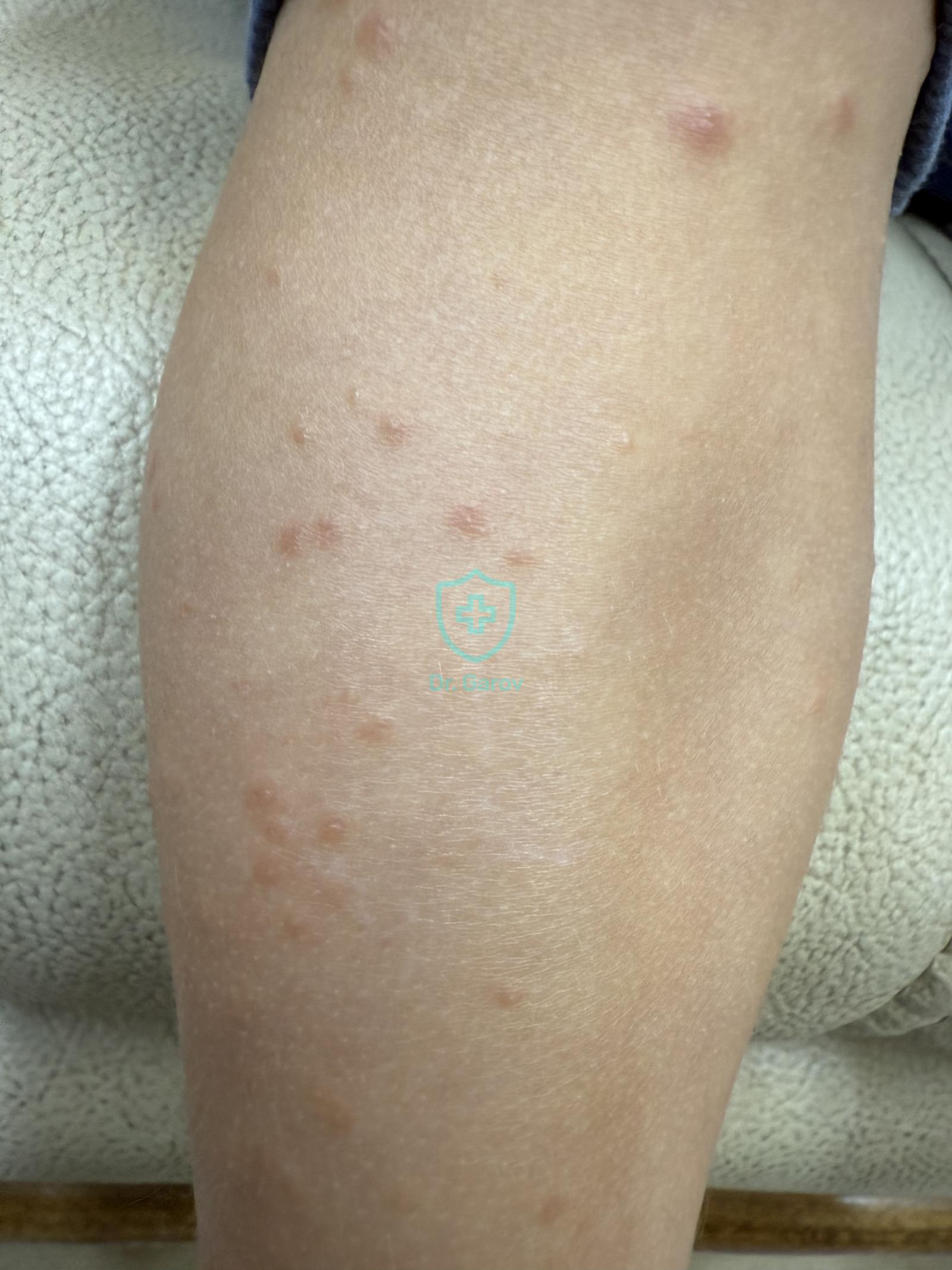 Gianotti–Crosti syndrome