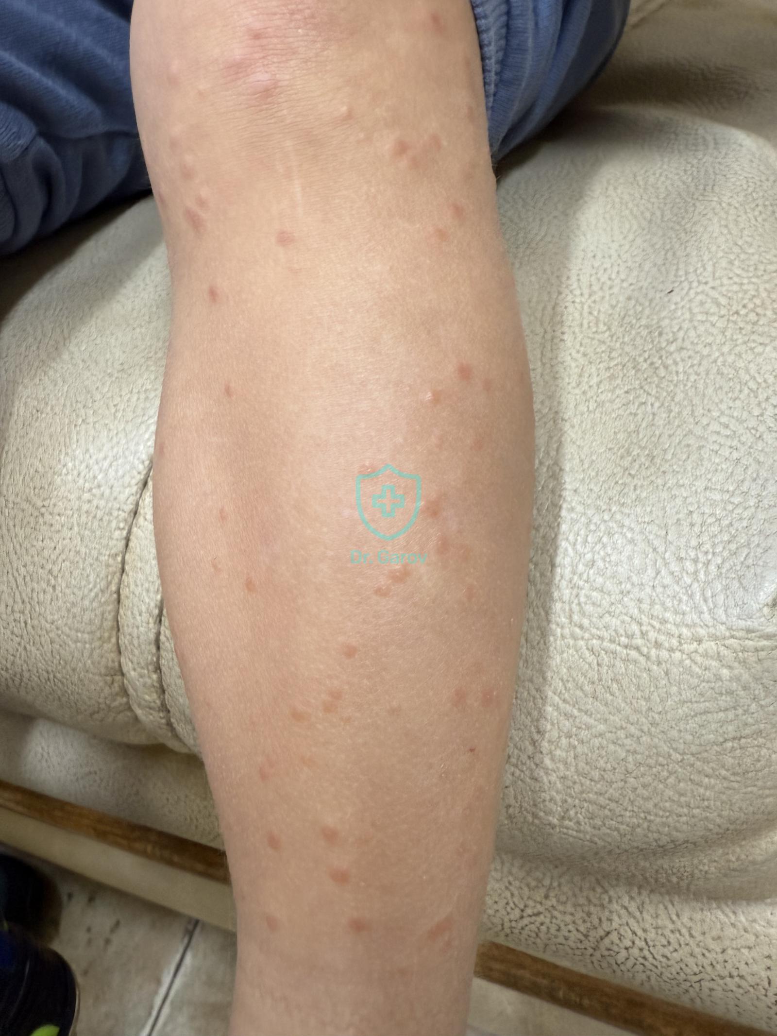 Gianotti–Crosti syndrome