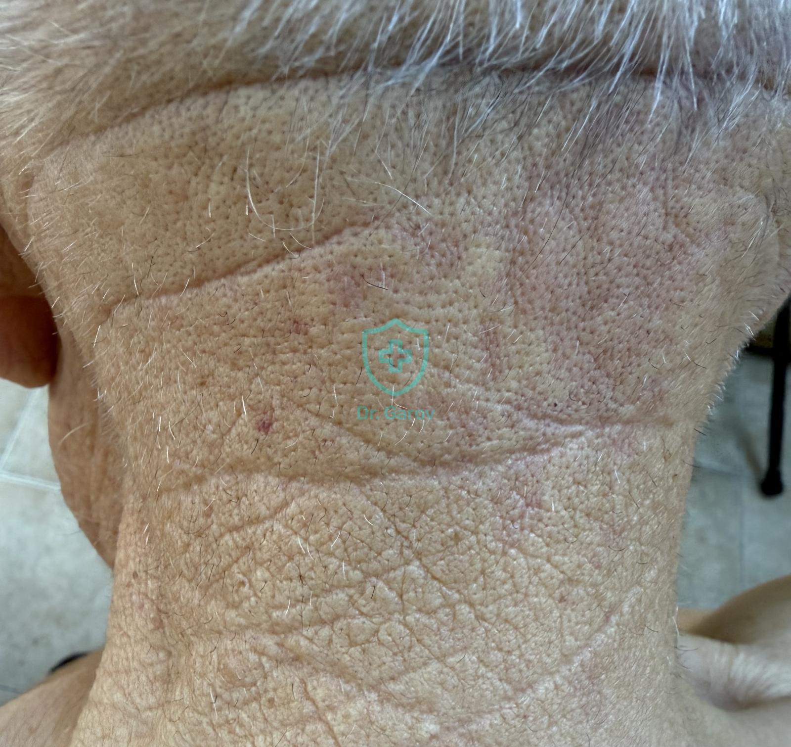 Syndroma Favre-Racouchot, Elastoidosis nodularis cystica et comedonica