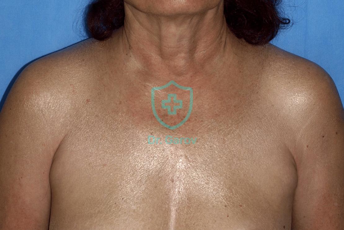 Scleroedema Buschke
